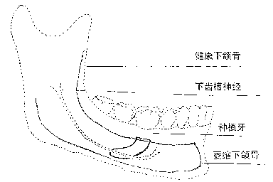 Implant used for artificial dental implant when bone mass of alveolar bone is insufficient