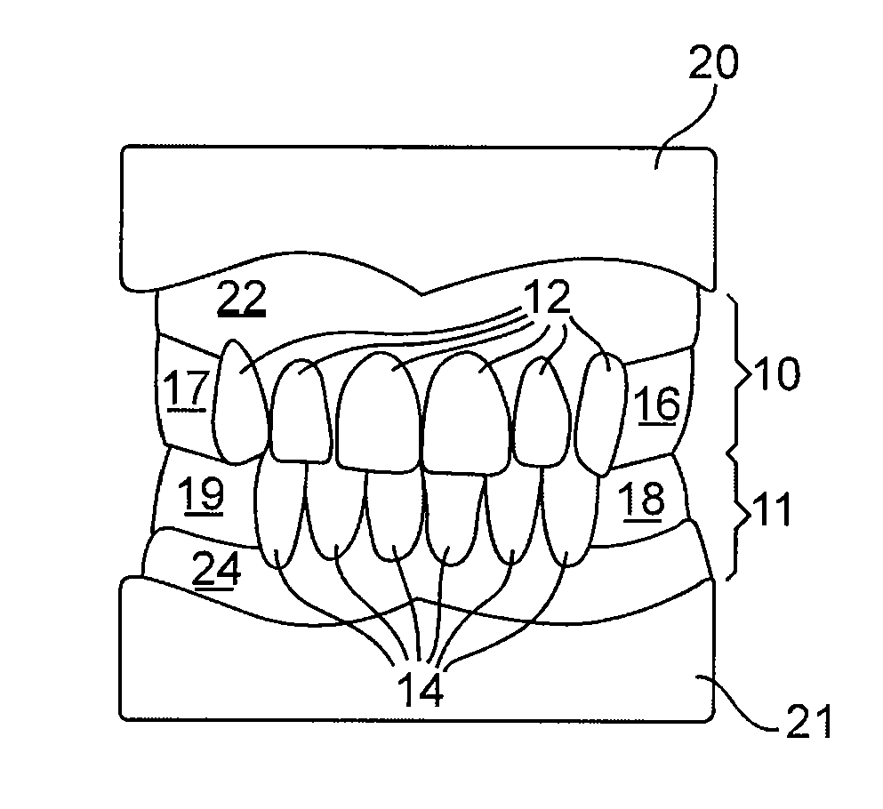 Treatment prostheses for edentulous dental patients