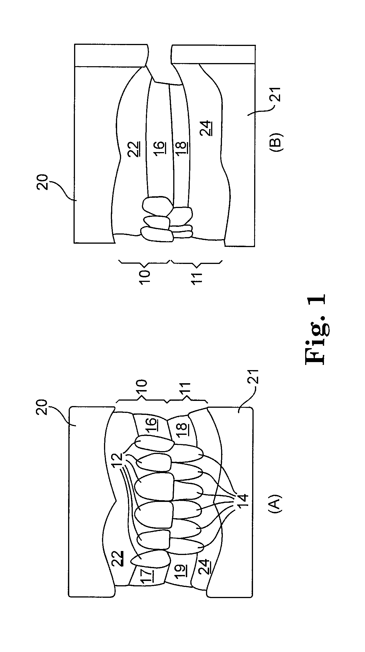 Treatment prostheses for edentulous dental patients