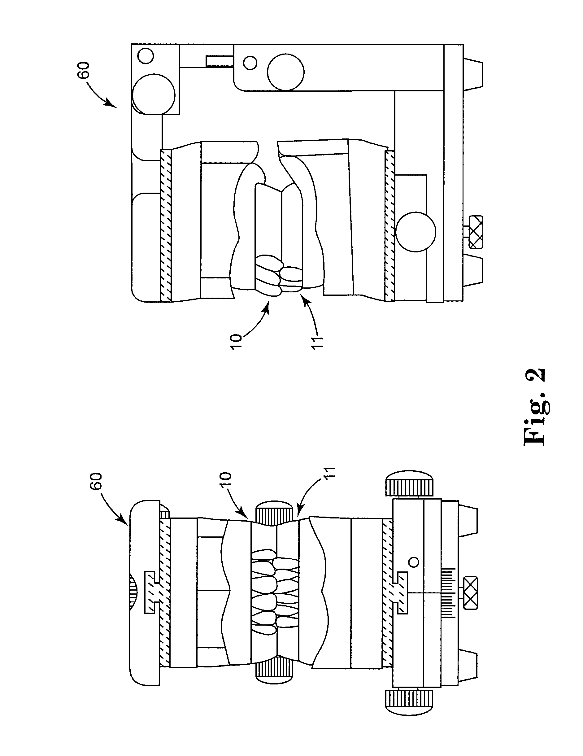 Treatment prostheses for edentulous dental patients