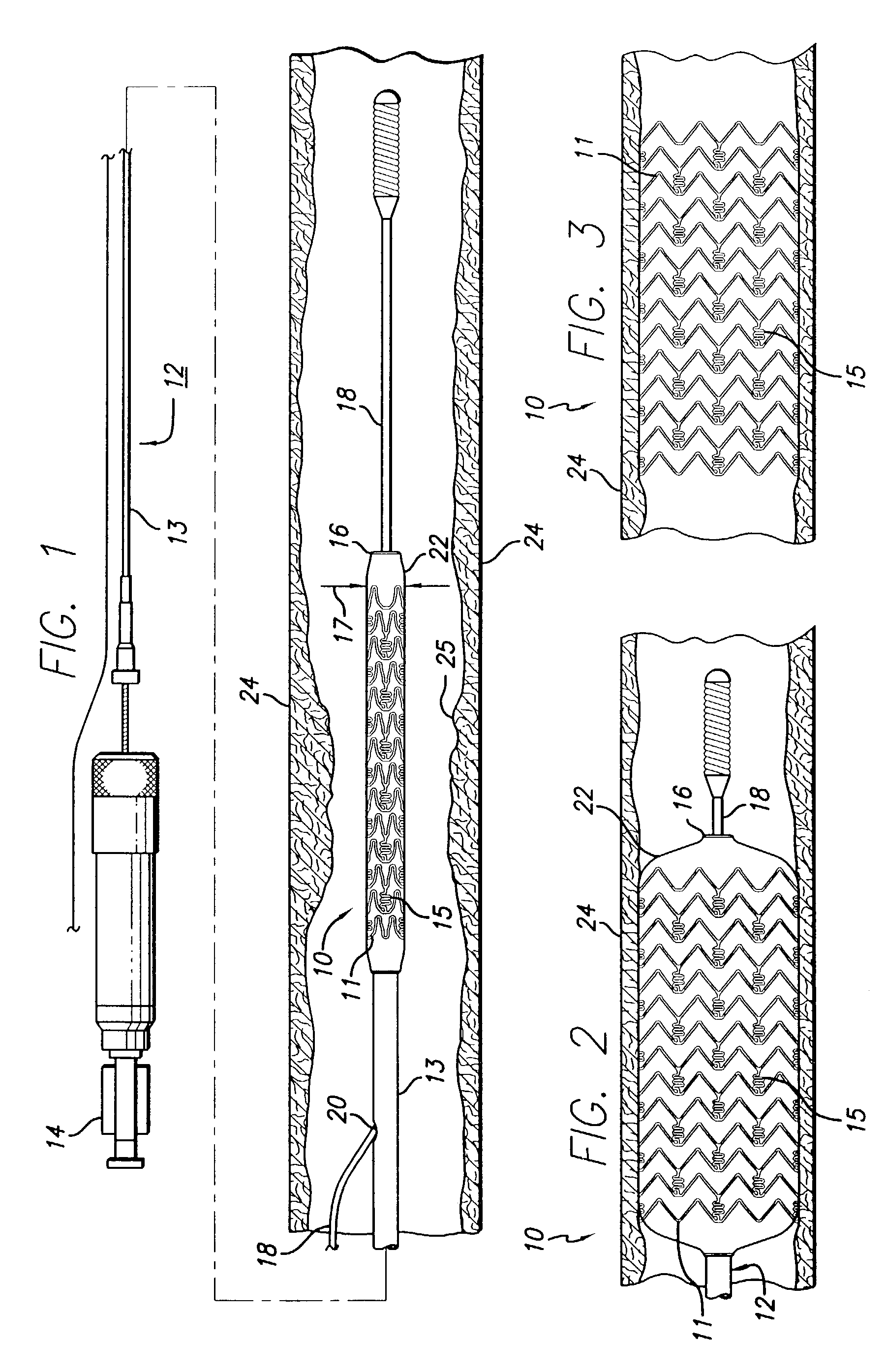 Drug-eluting stent and methods of making the same