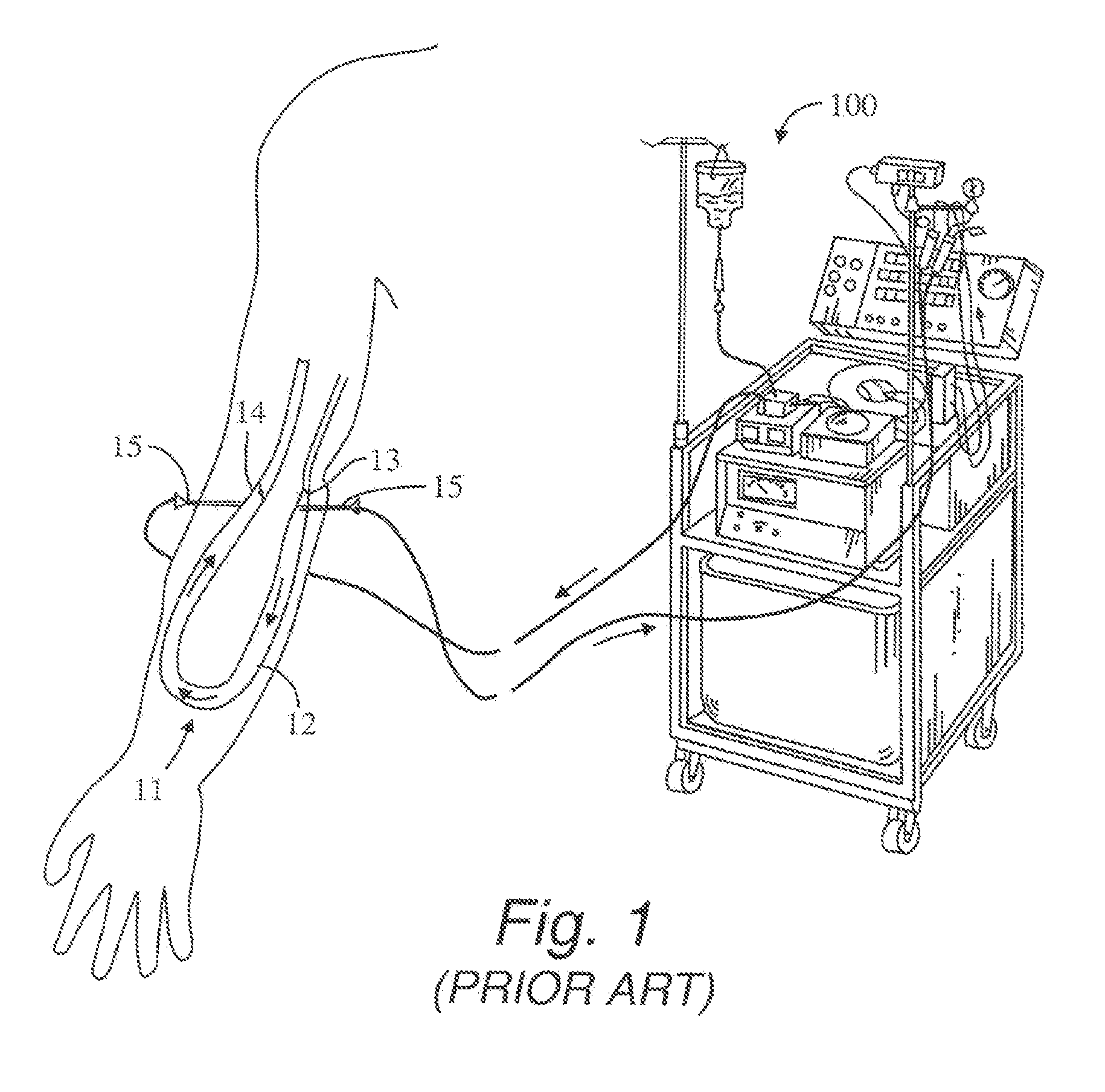 A-V dialysis graft