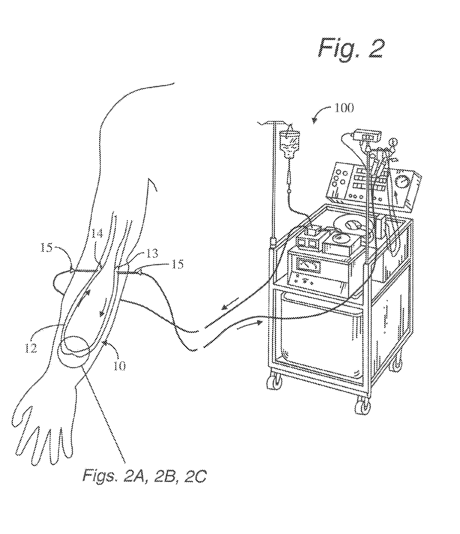 A-V dialysis graft