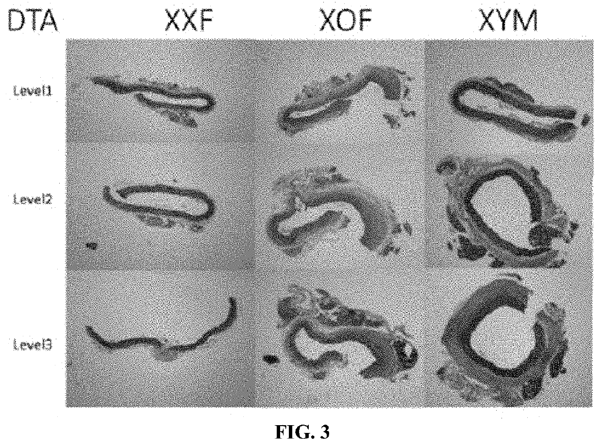 5HT3R Antagonist For Use in Treating Aneurysms and Cardiovascular Risk