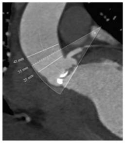 Transcatheter aortic valve replacement postoperative complication prediction method, device and equipment