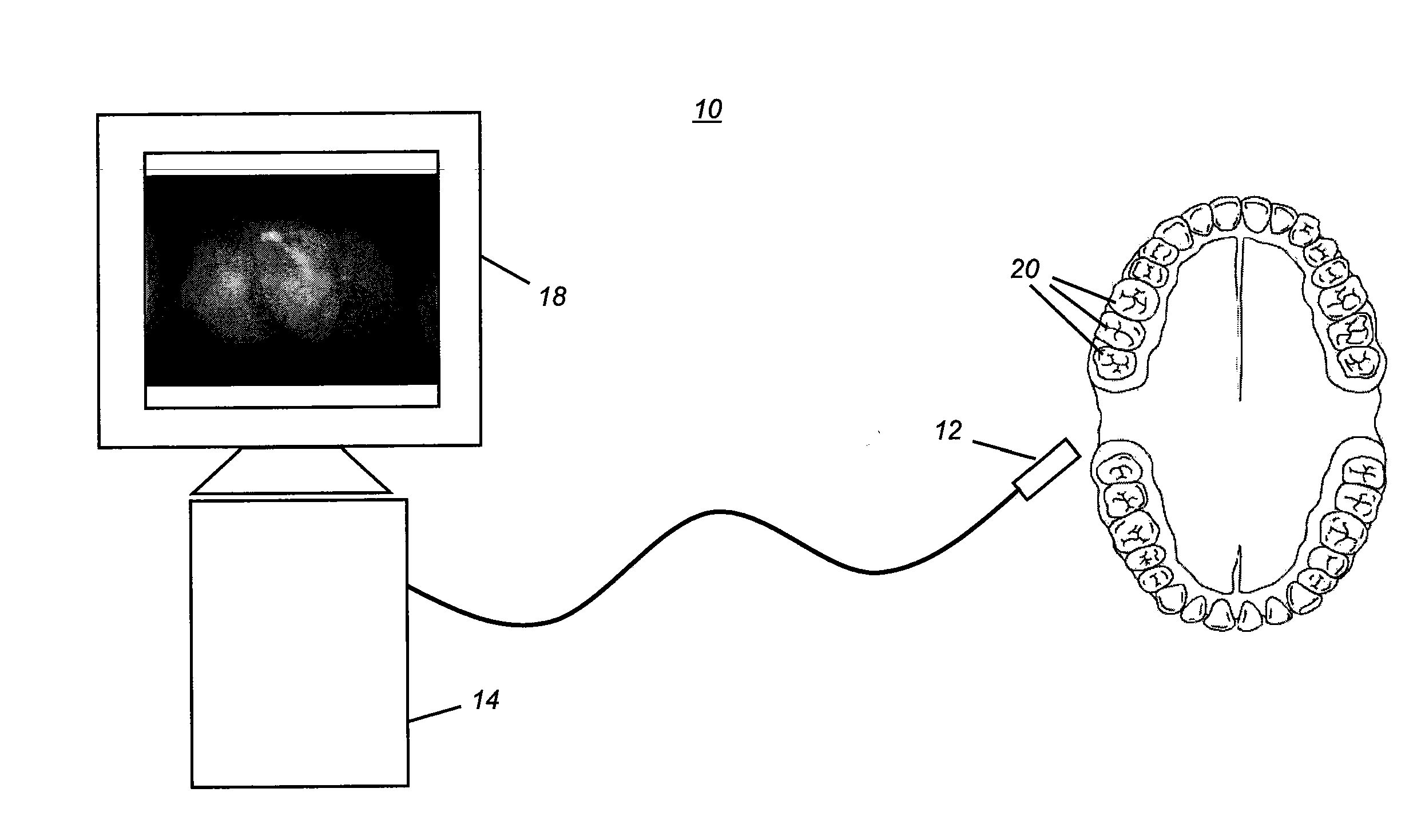 Method for real-time visualization of caries condition