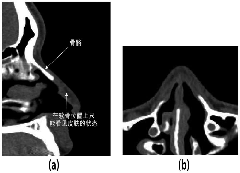 Nose implant manufacturing method