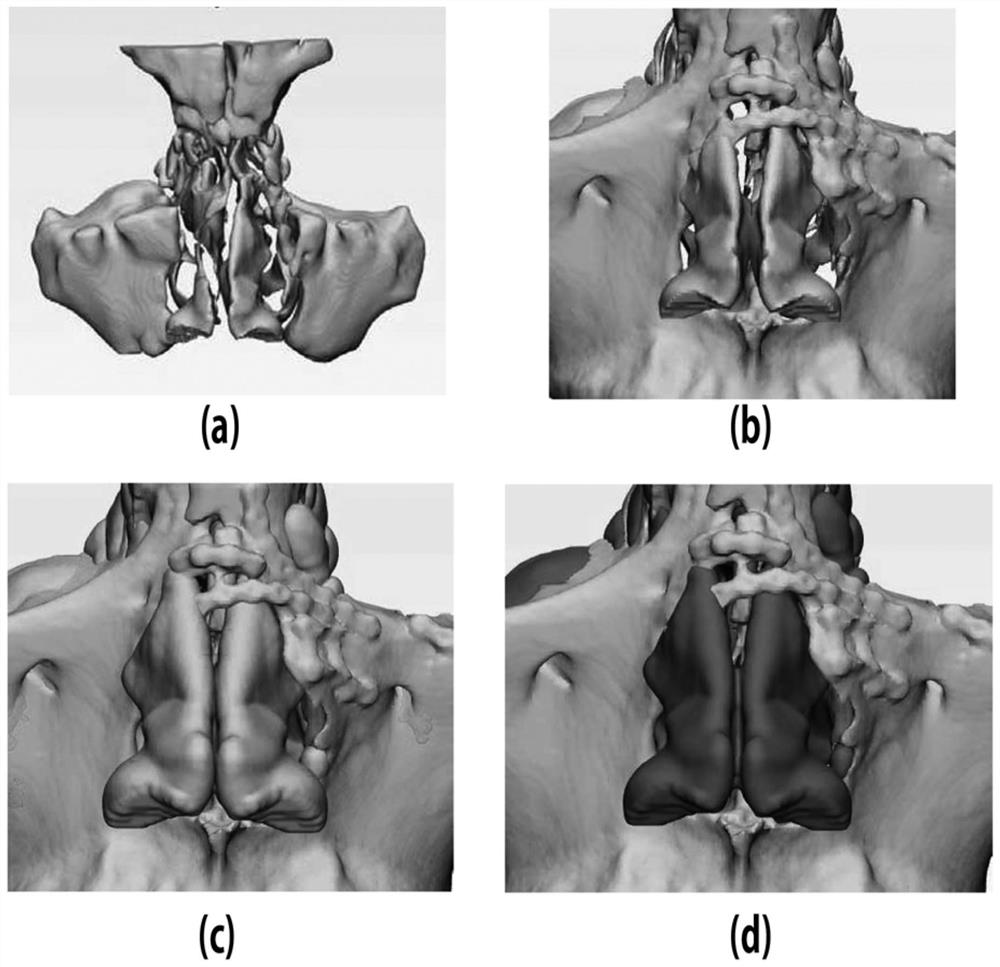 Nose implant manufacturing method