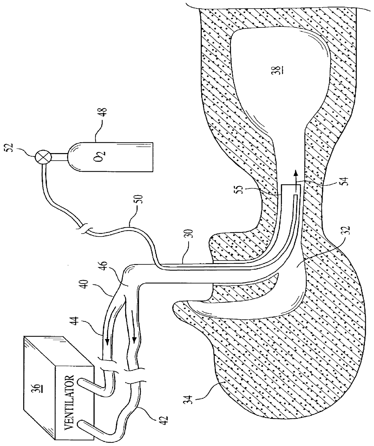 Insufflation system, attachment and method