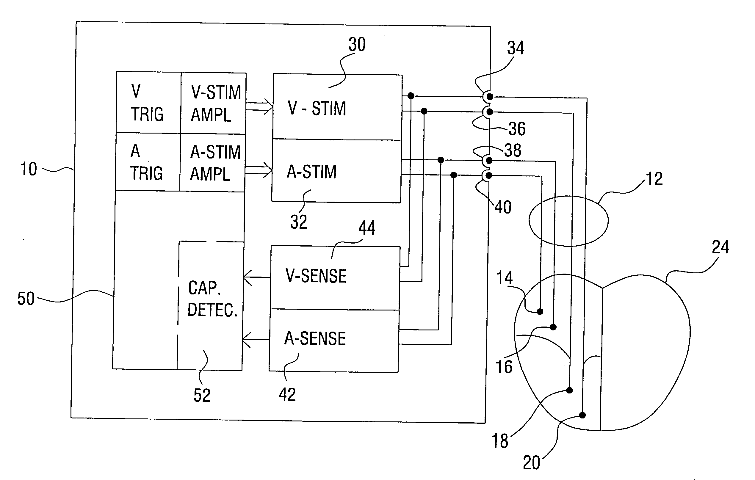 Cardiac pacemaker