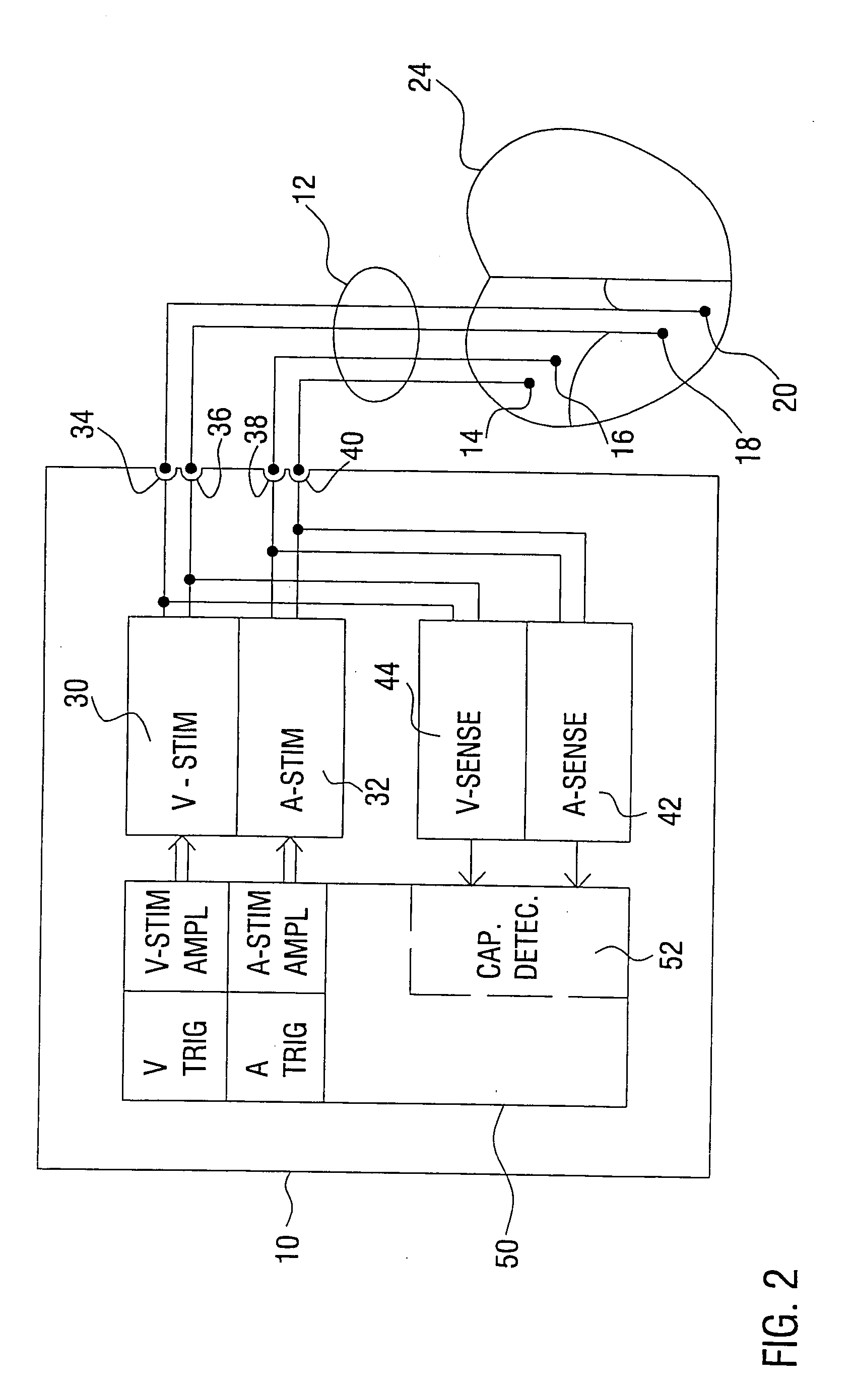 Cardiac pacemaker