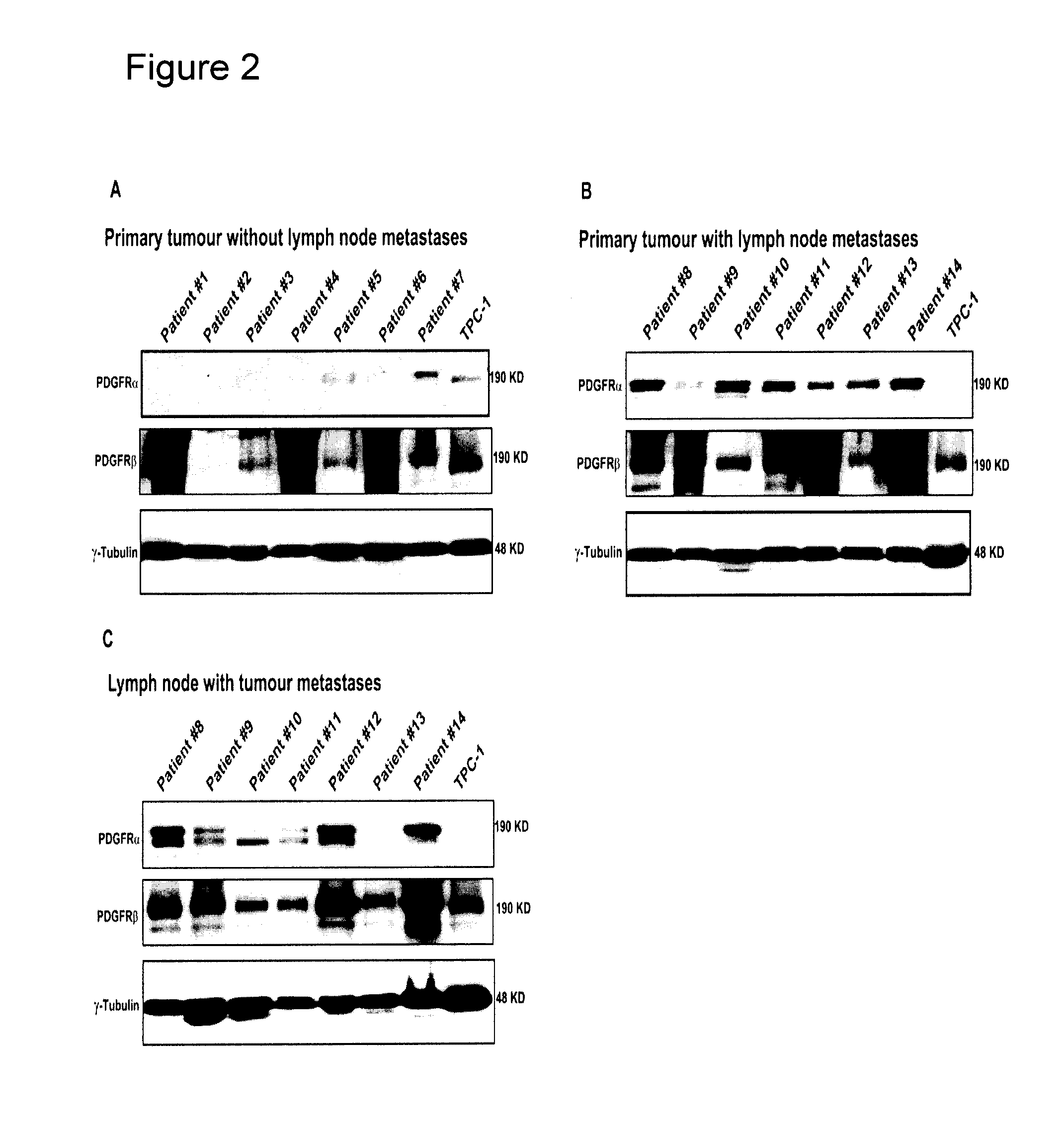 Use of pdgfr-alpha as diagnostic marker for papillary thyroid cancer