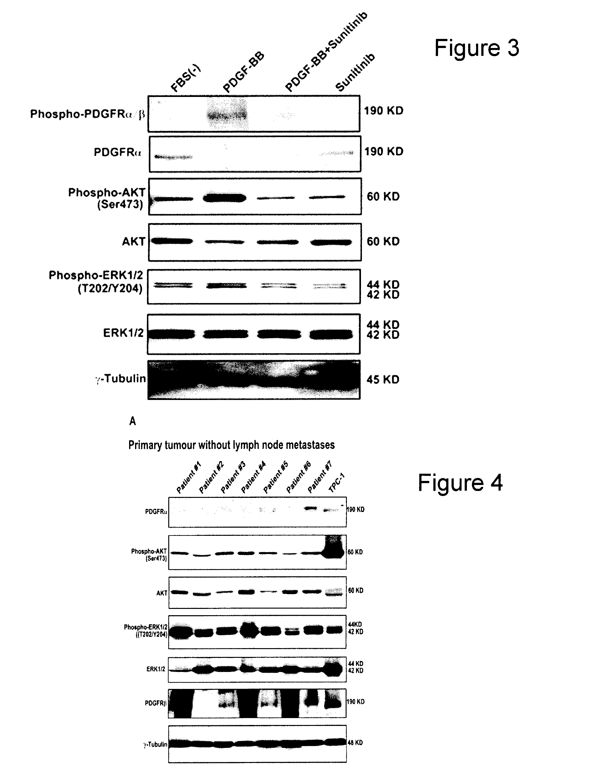 Use of pdgfr-alpha as diagnostic marker for papillary thyroid cancer