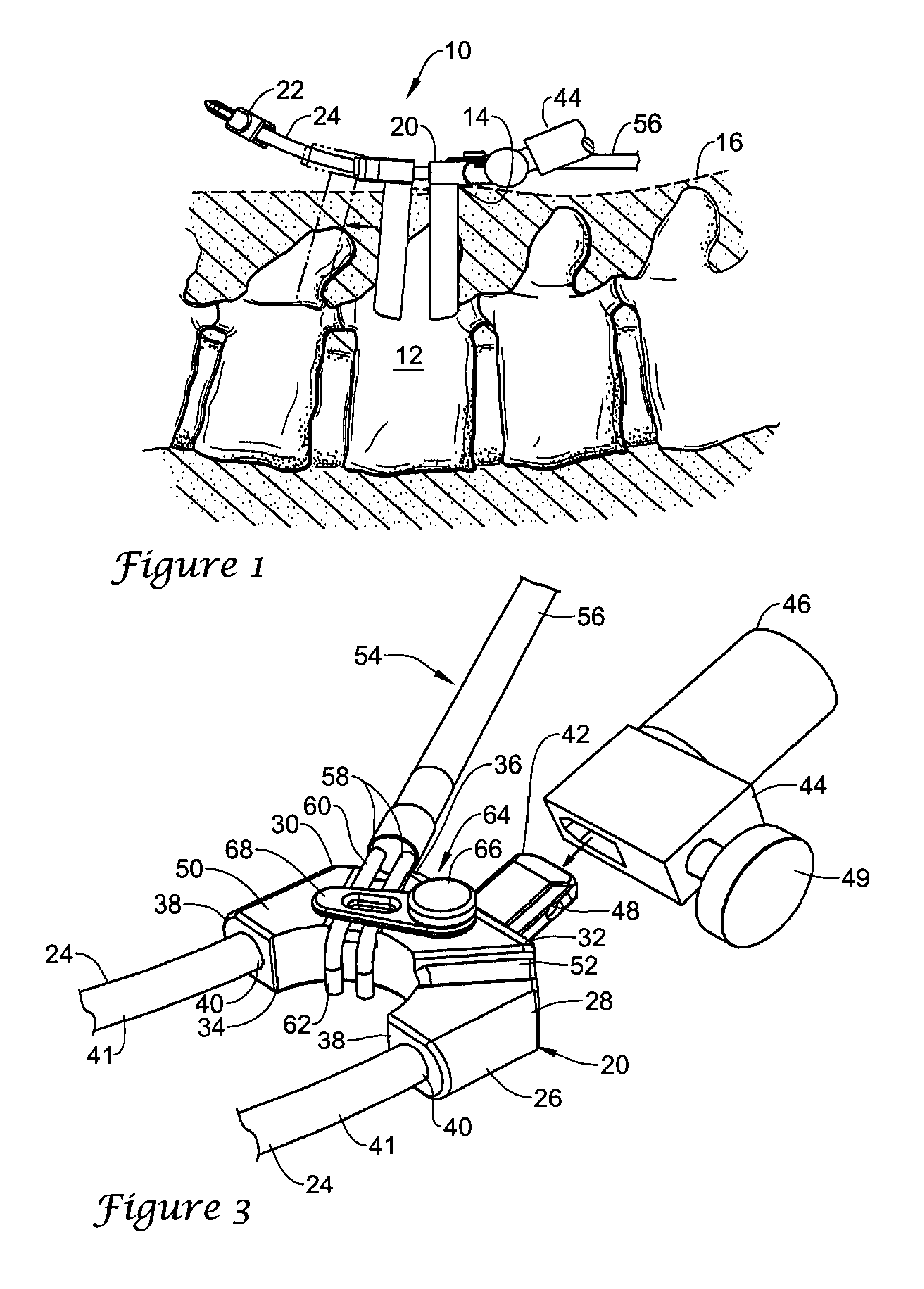 Surgical access system and method of using the same