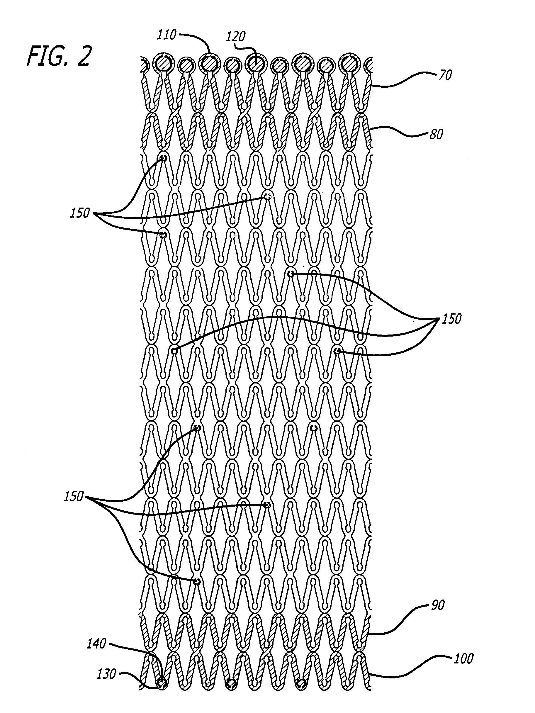 Implantable Stent with Degradable Portions