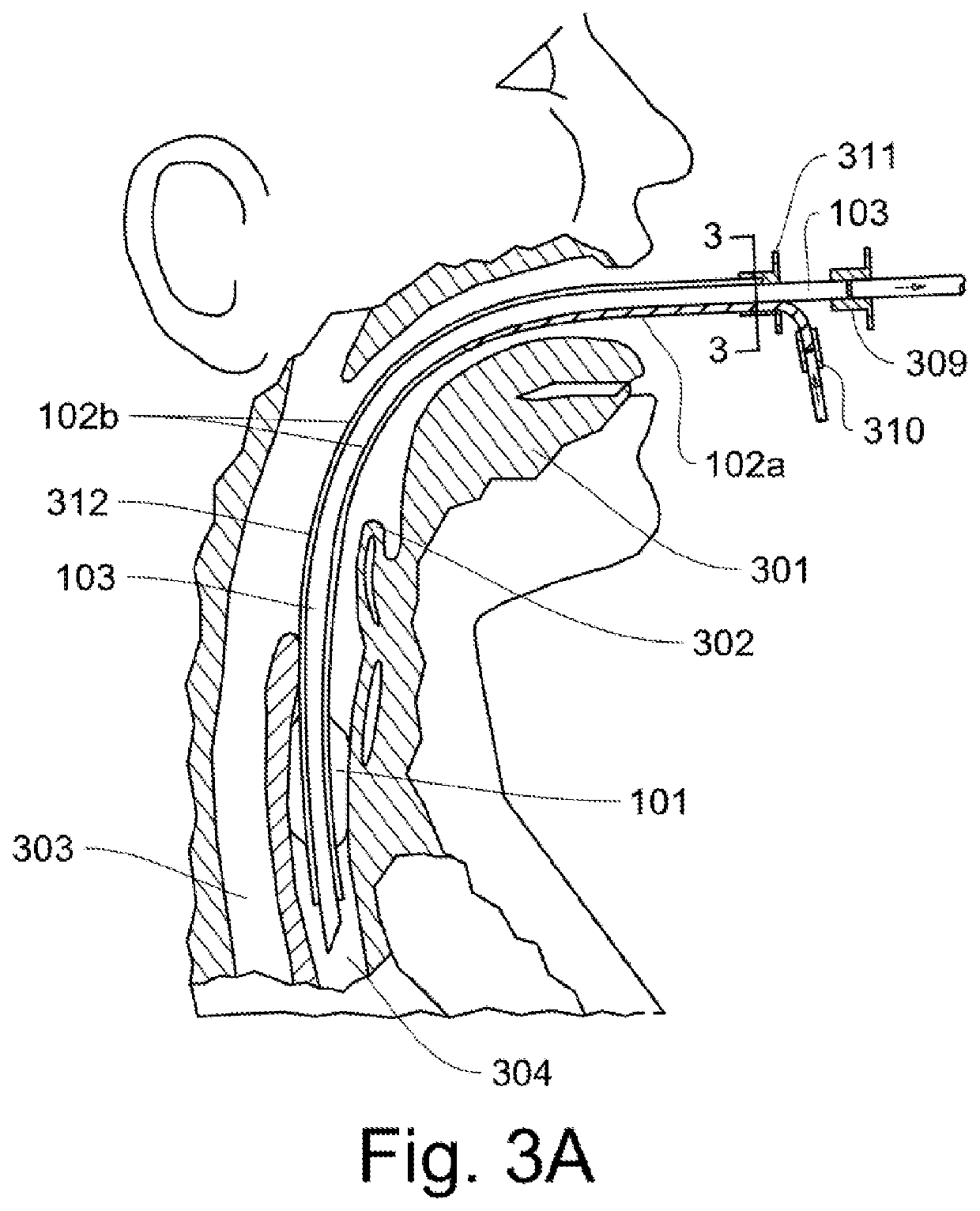 Patient Ventilator Control Using Constant Flow and Breathing Triggers