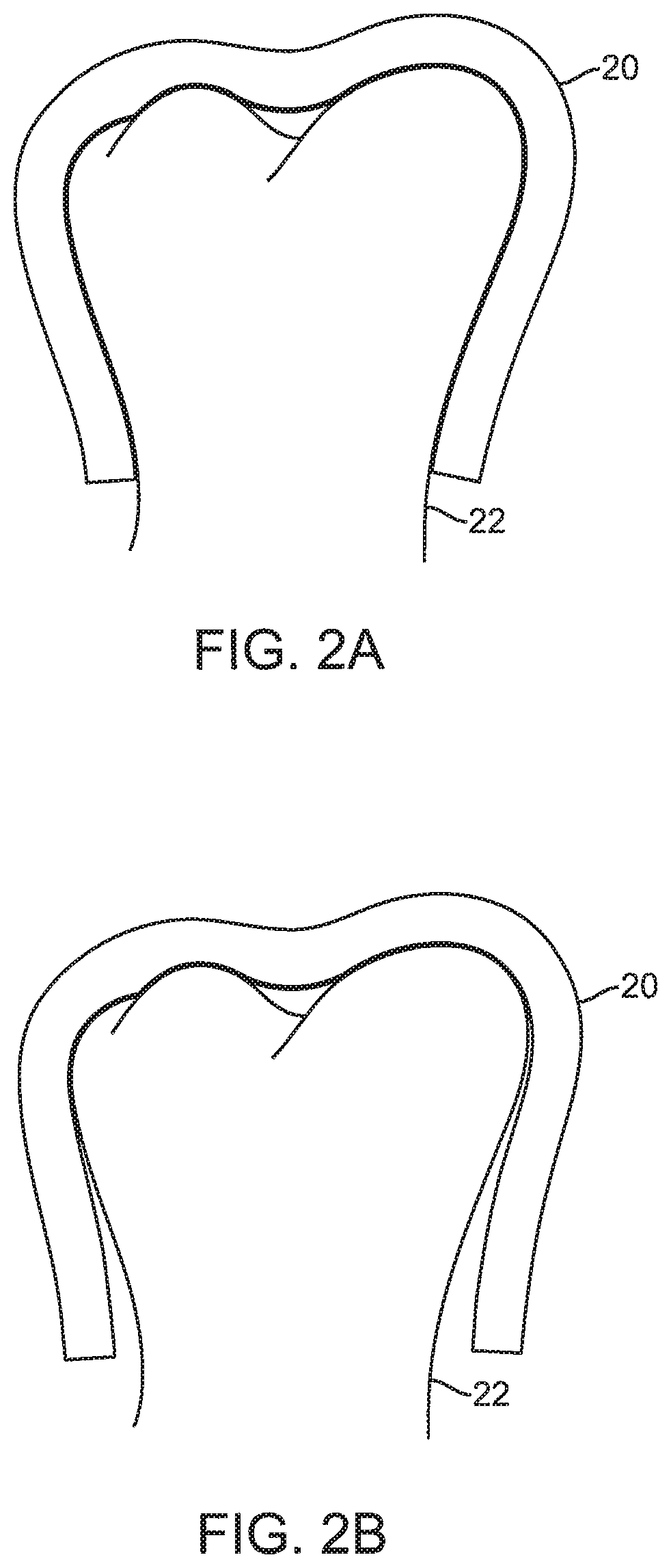 Shape engineered aligner—auto shaping