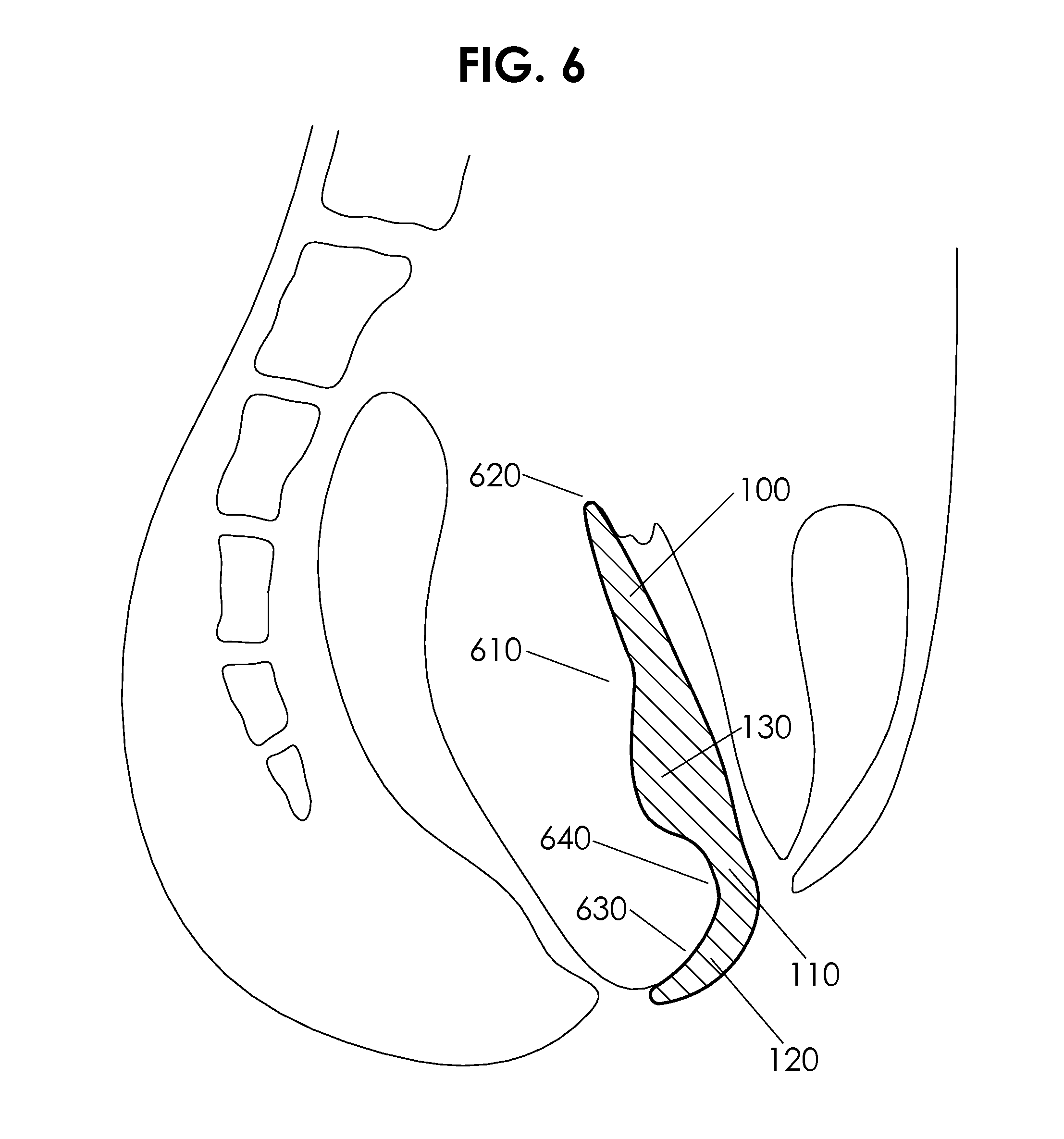 Female posterior wall prosthesis