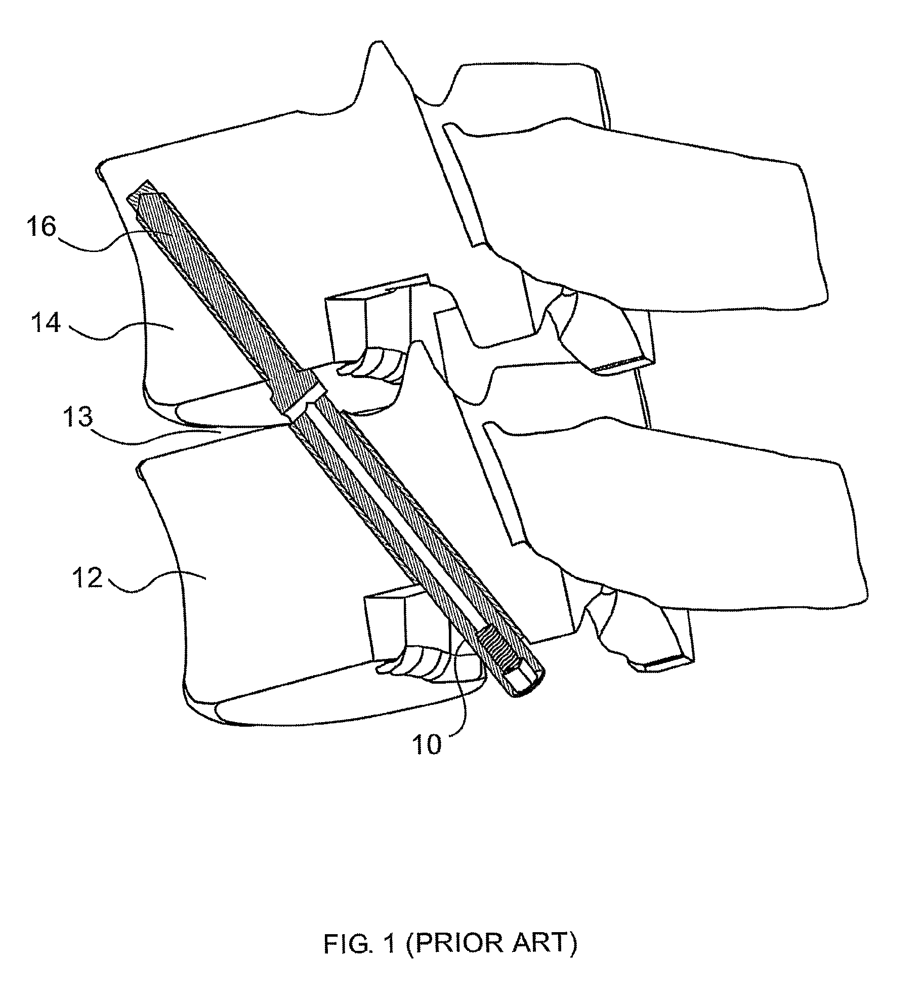 Segmented insert for intervertebral support