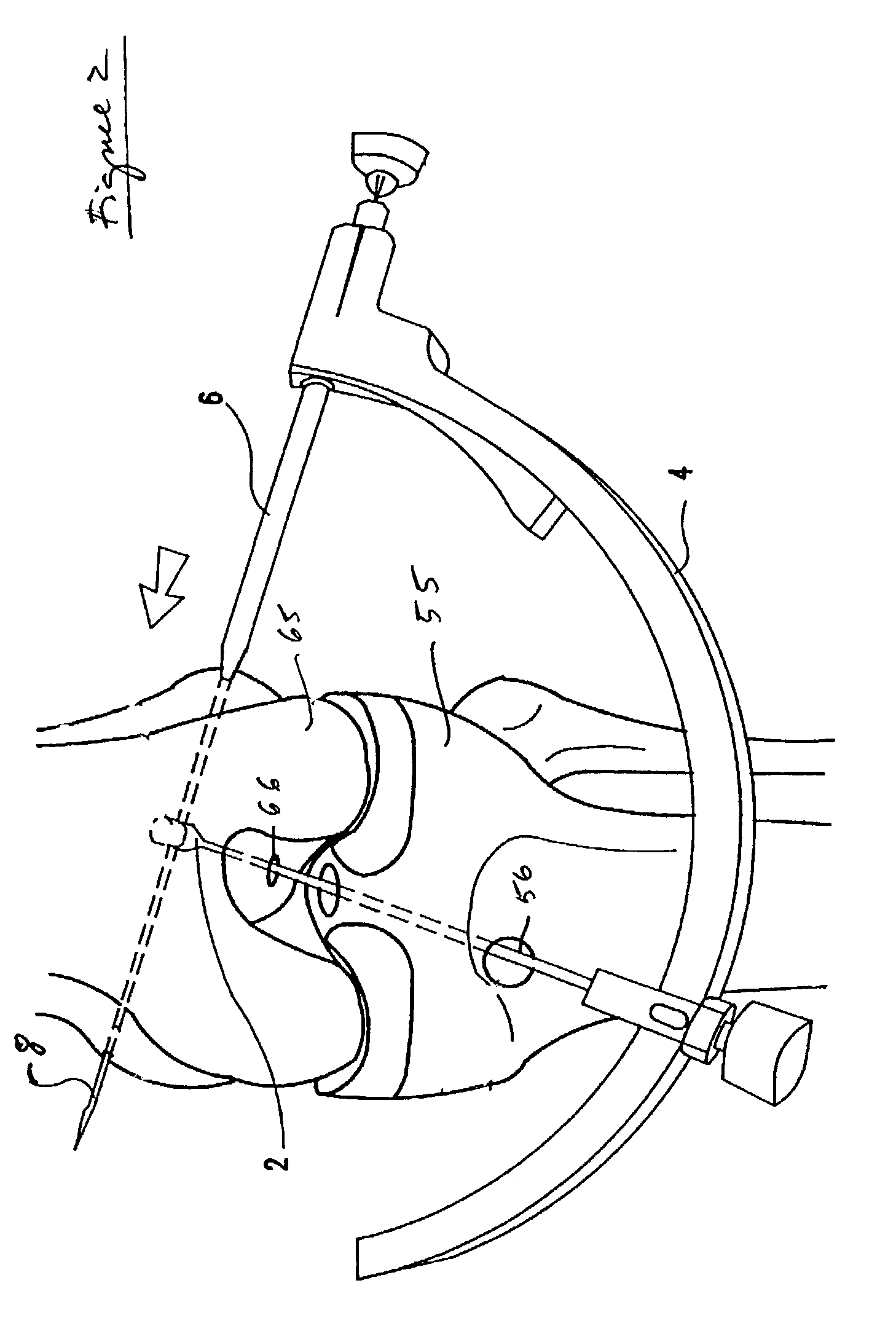 Transverse fixation technique for ACL reconstruction using bone-tendon-bone graft