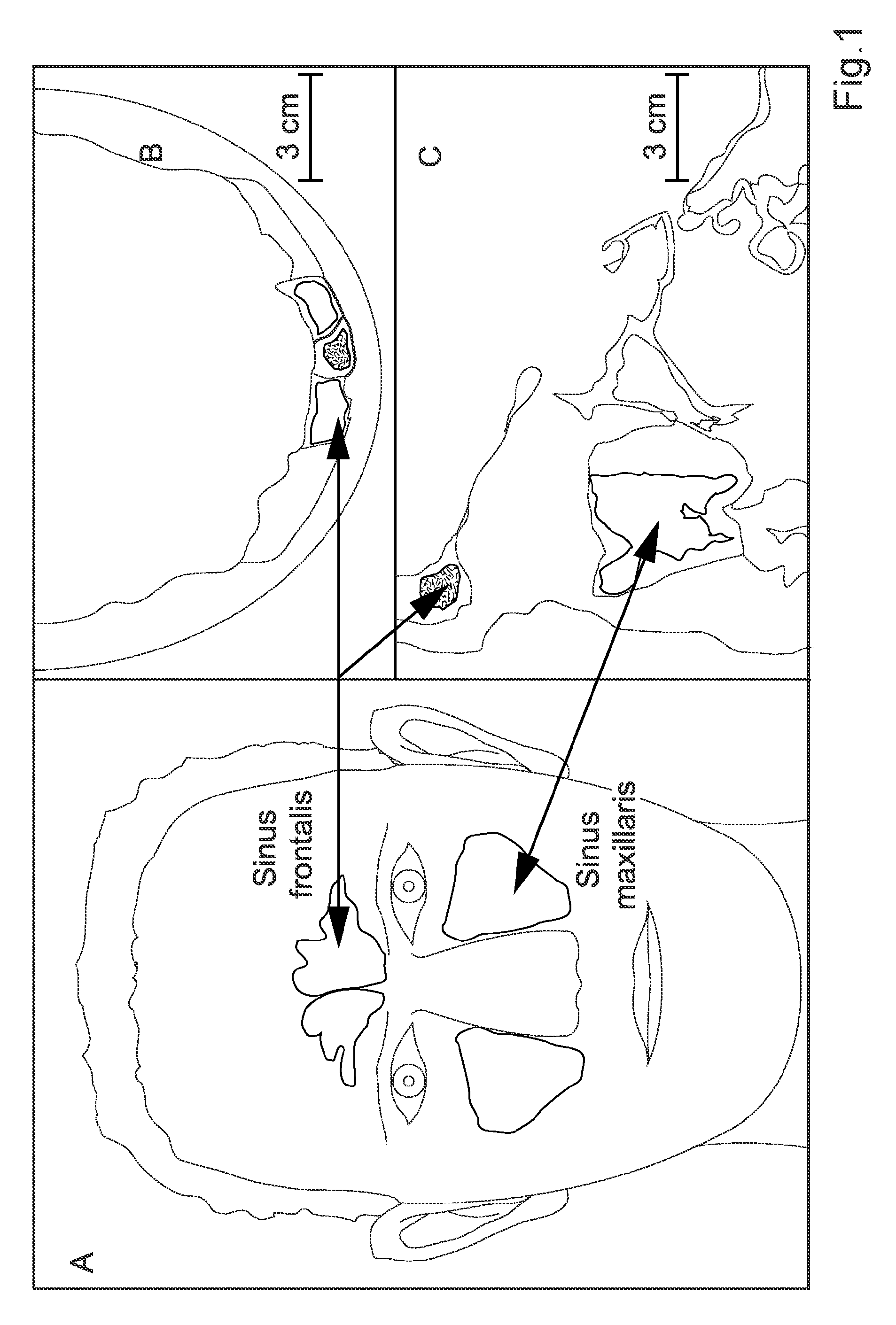 Human cavity gas measurement device and method