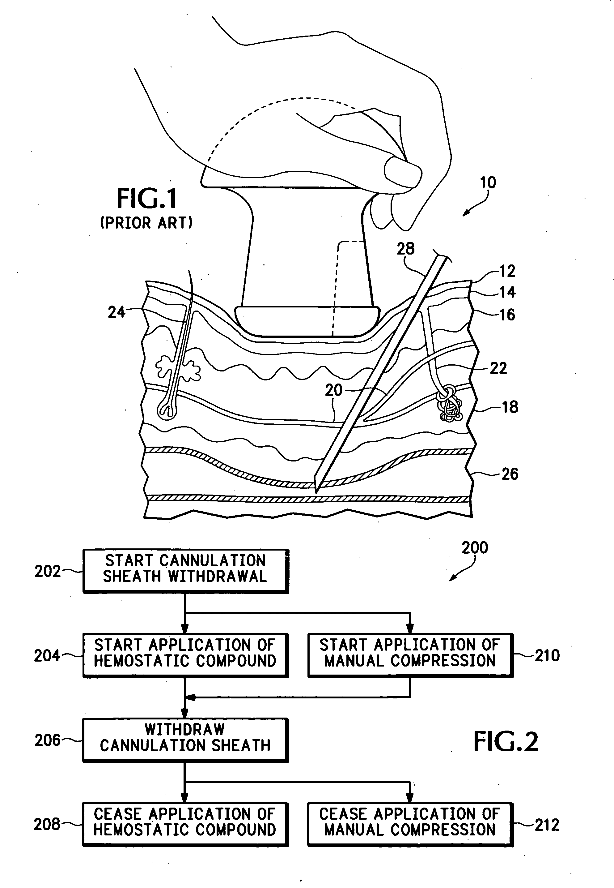 Hemostatic compound and its use