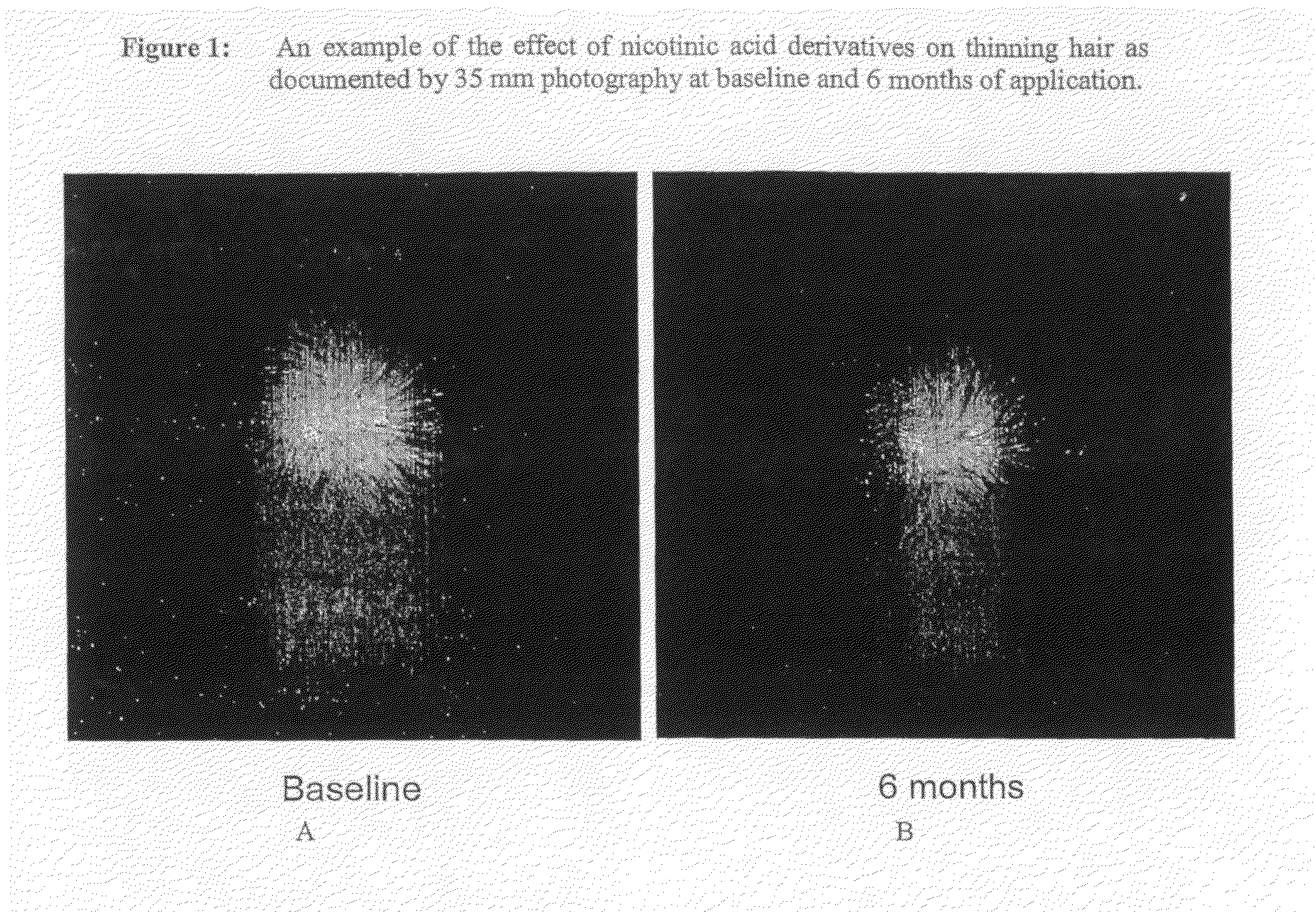 Method for treating hair growth disorders, such as female pattern alopecia, and compositions useful therefore