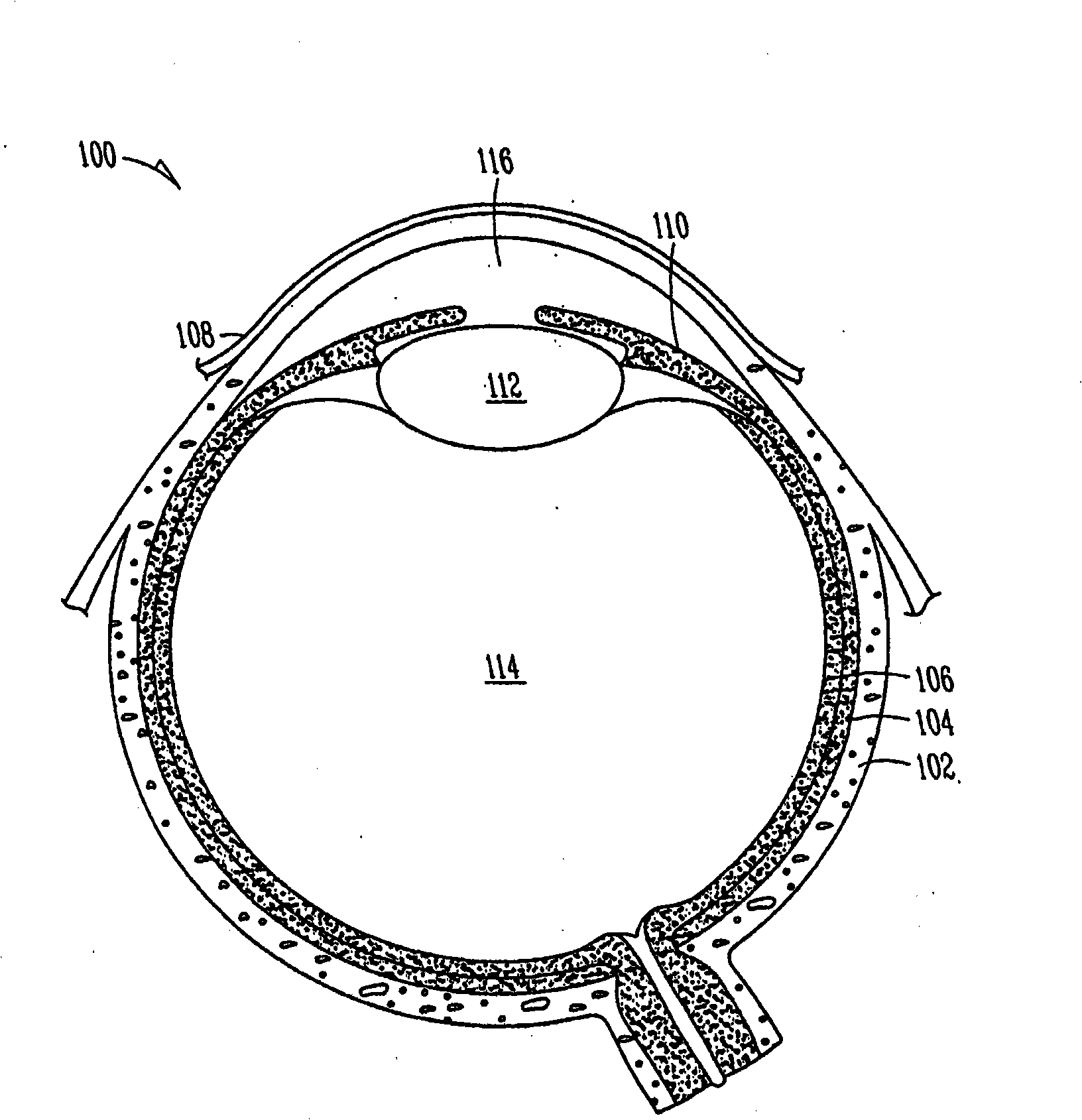 Lacrimal implants and related methods