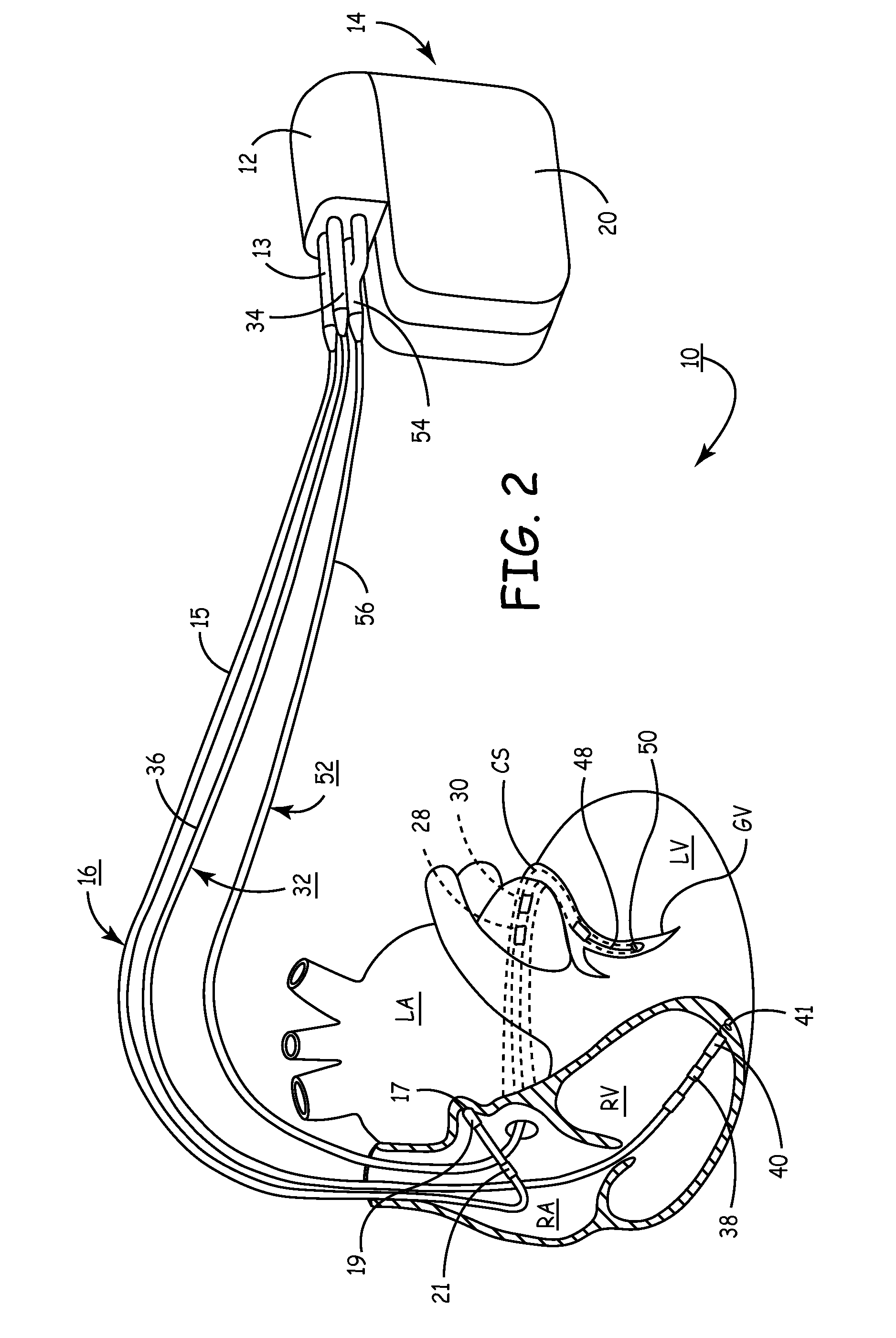 Apparatus and methods for automatic adjustment of av interval to ensure delivery of cardiac resynchronization therapy