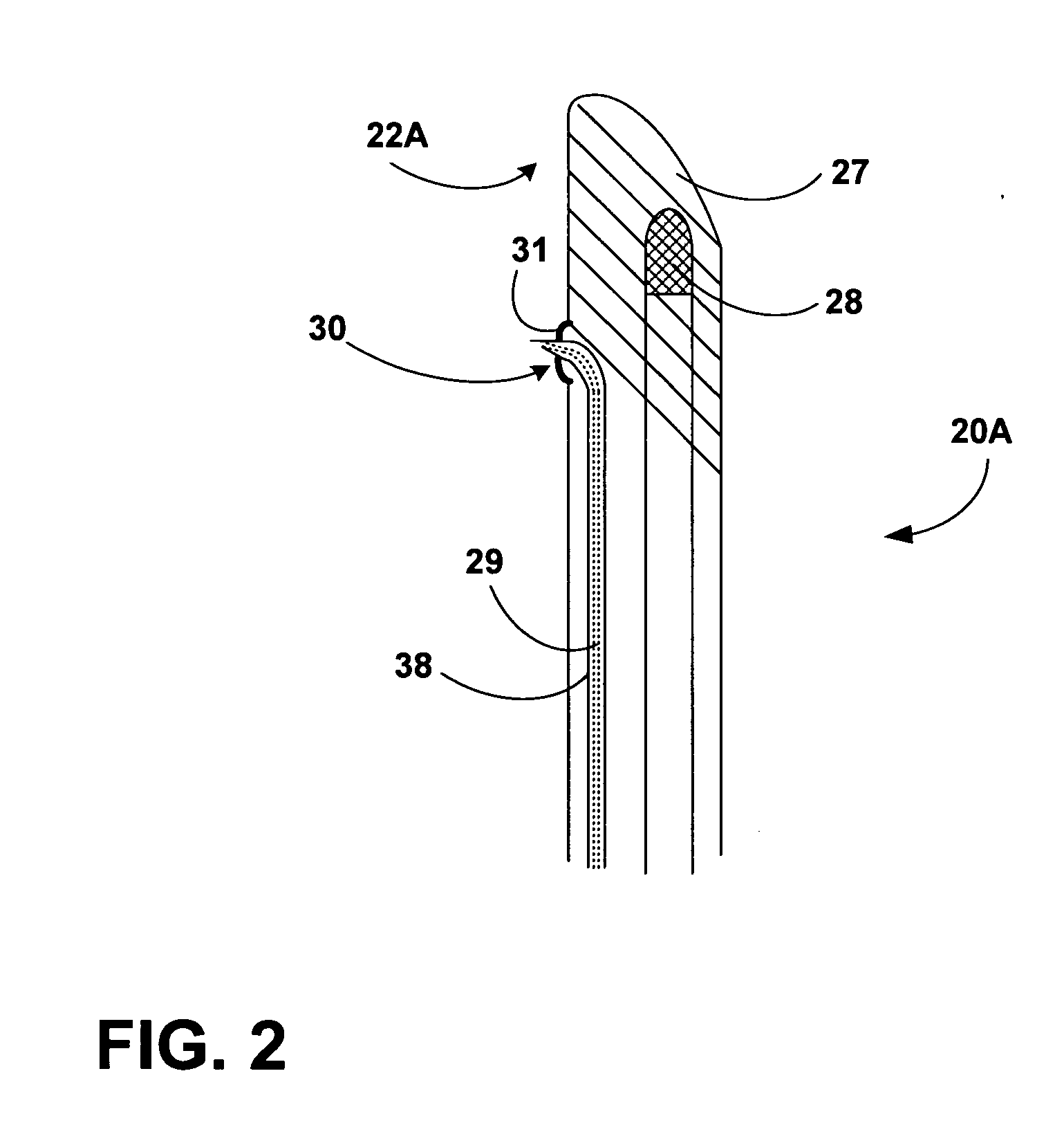 Techniques for transrectal delivery of a denervating agent to the prostate gland