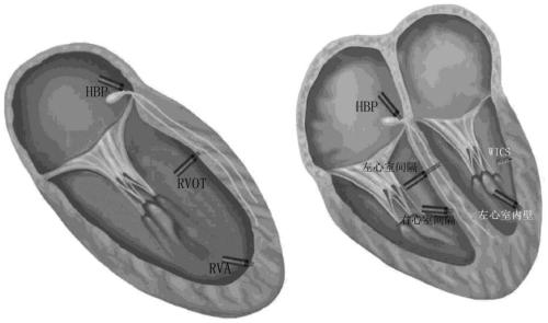 Pacemaker lead for cerclage pacing