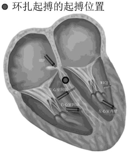 Pacemaker lead for cerclage pacing