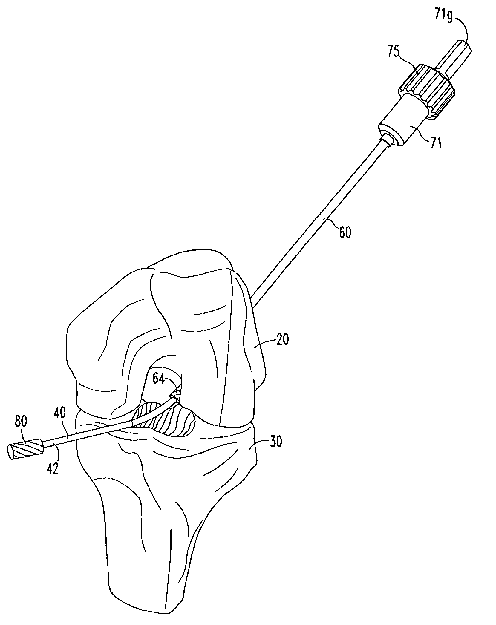 Retrodrill system