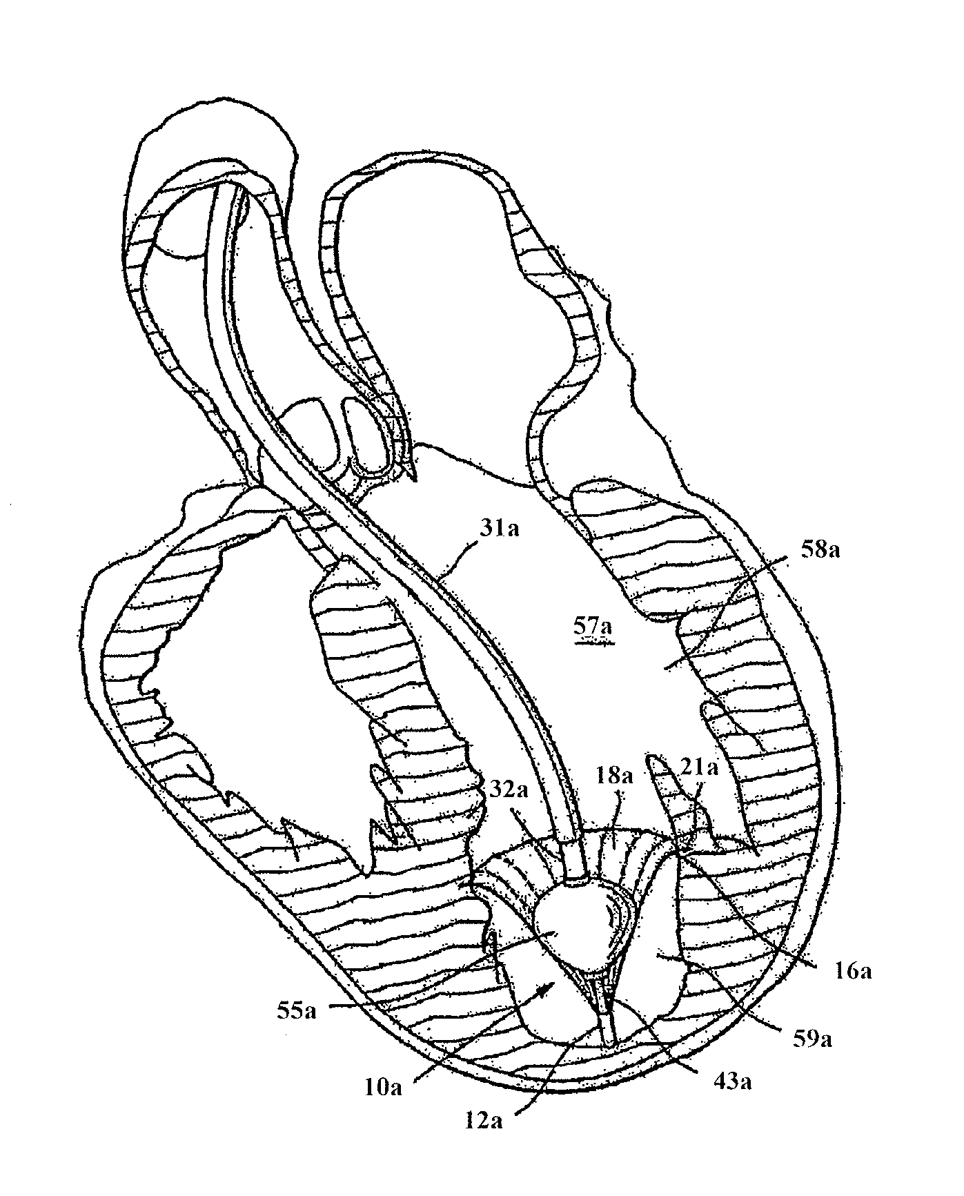 Devices and methods for delivering an endocardial device