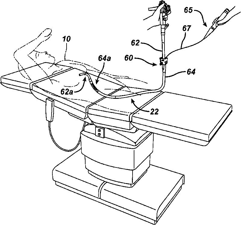 Methods and devices for performing gastrectomies and gastroplasties