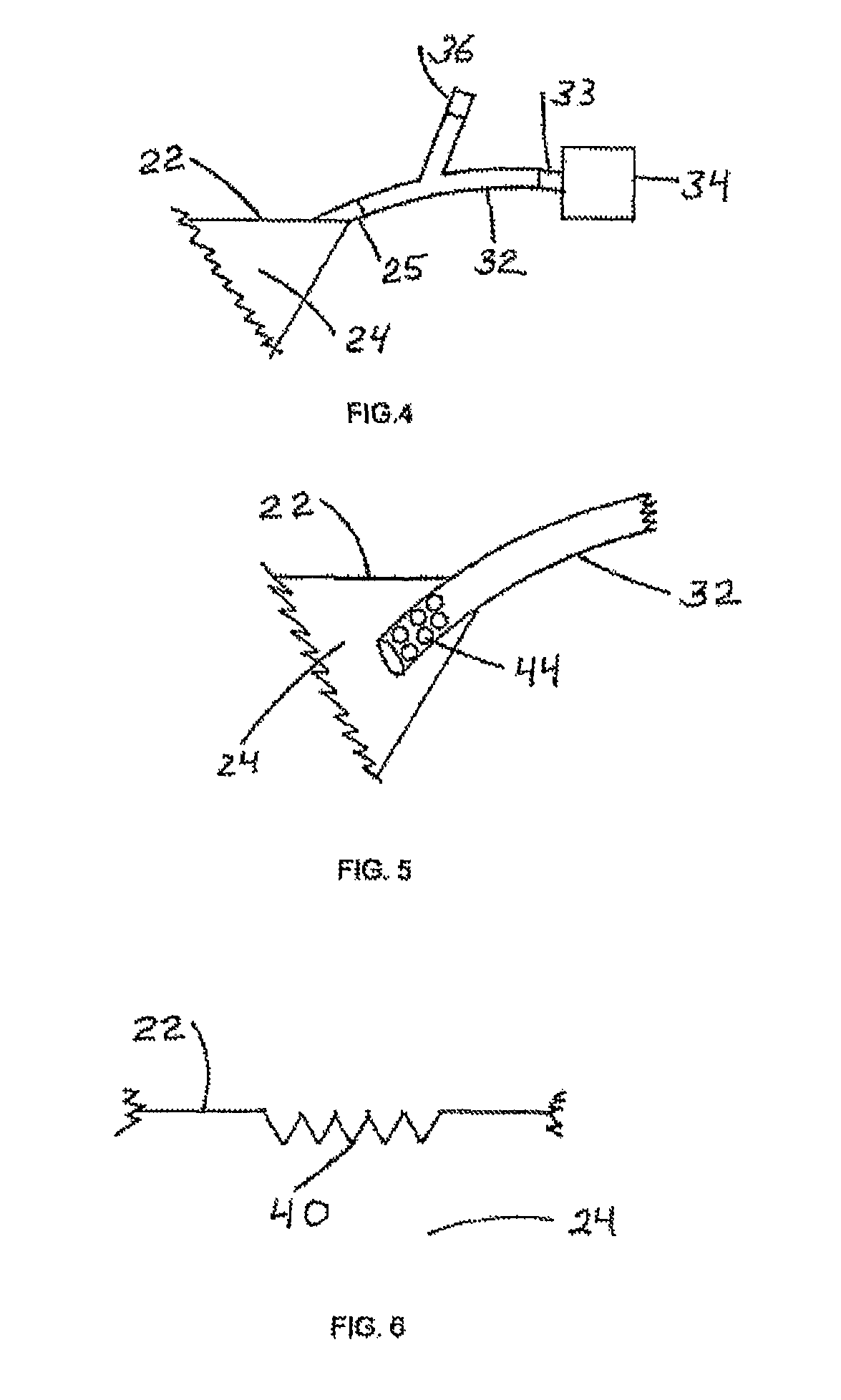 Wound treatment device employing negative pressure