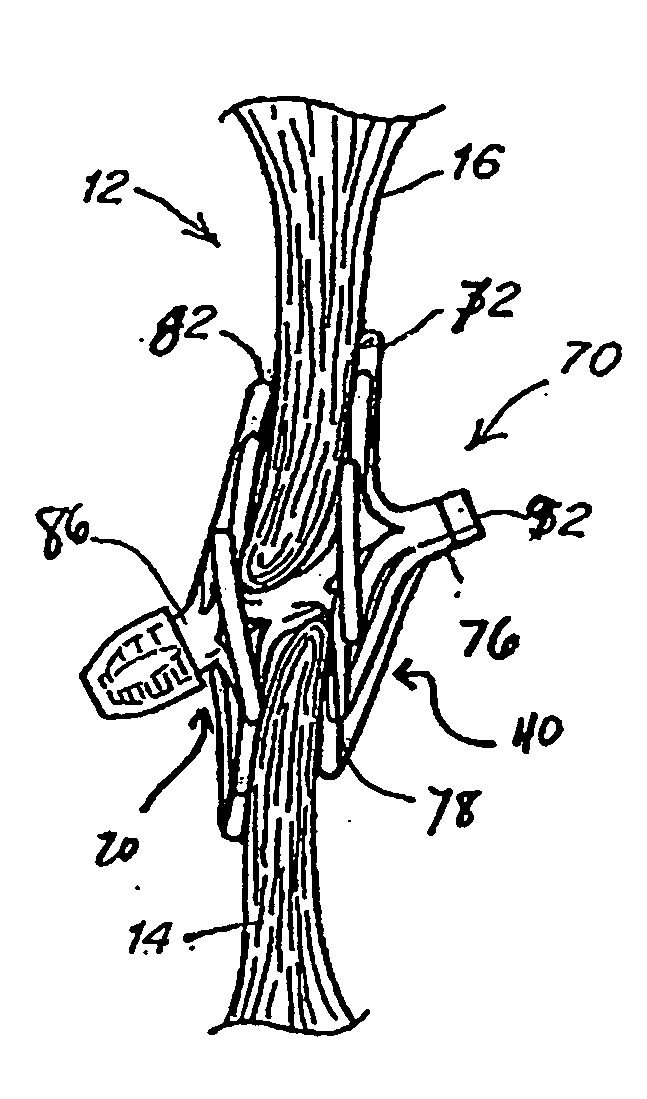 Catch system with locking cap for patent foramen ovale (PFO) occluder