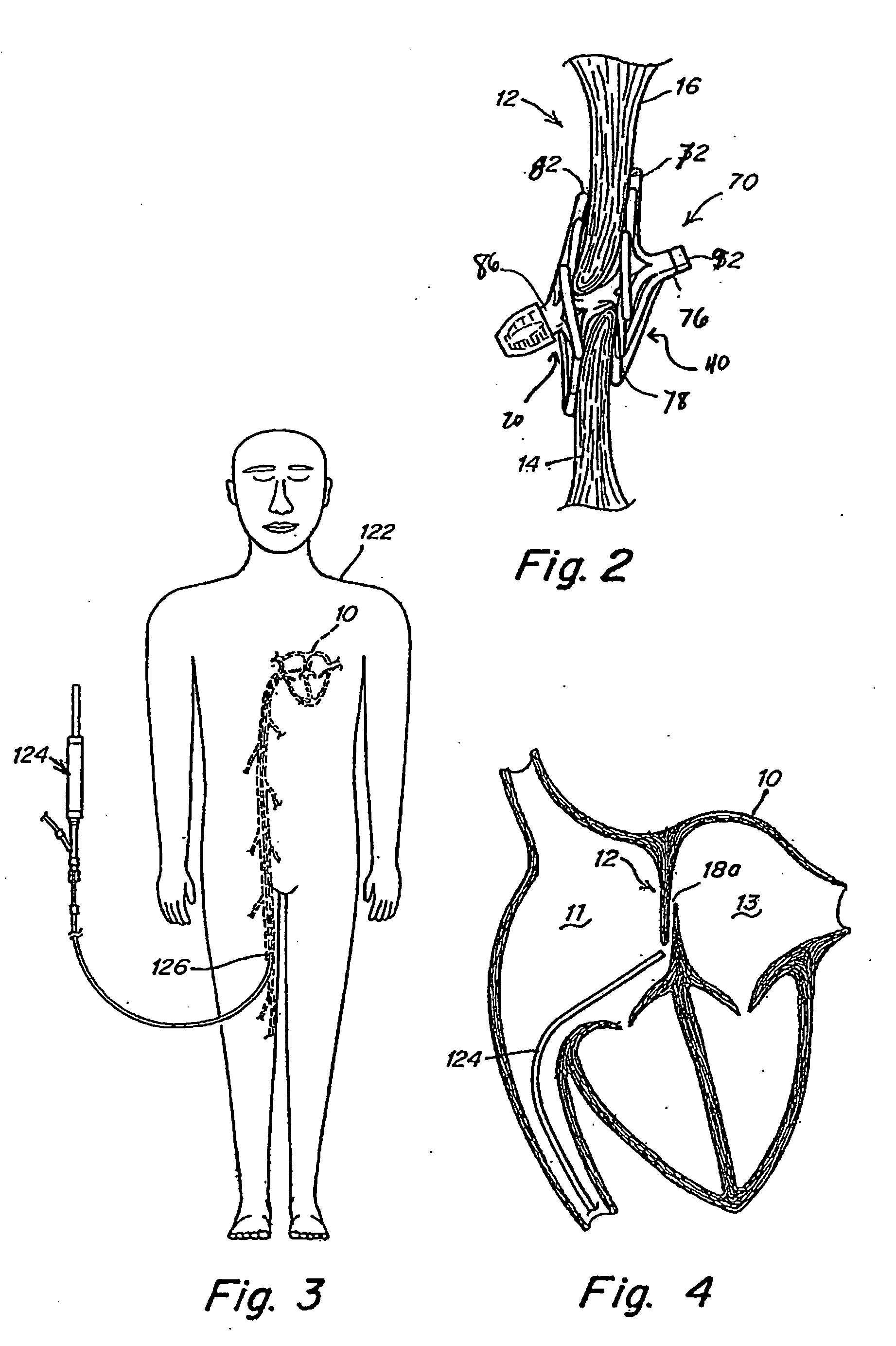 Catch system with locking cap for patent foramen ovale (PFO) occluder