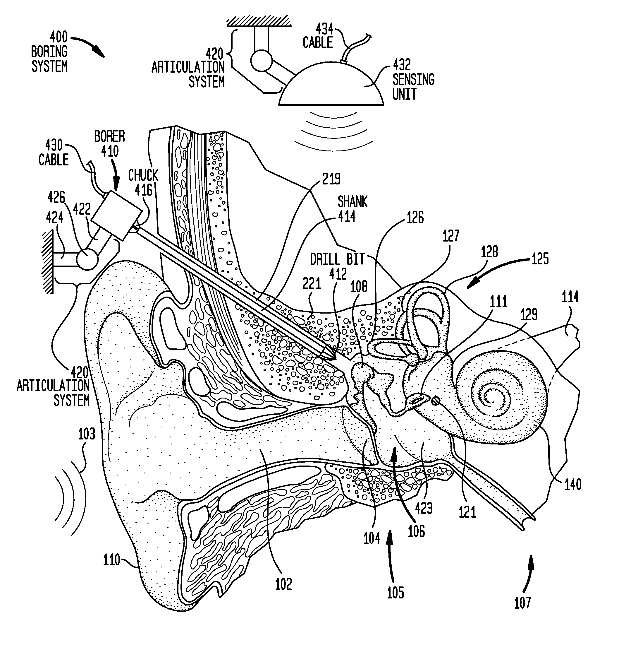 Implantation of a hearing prosthesis