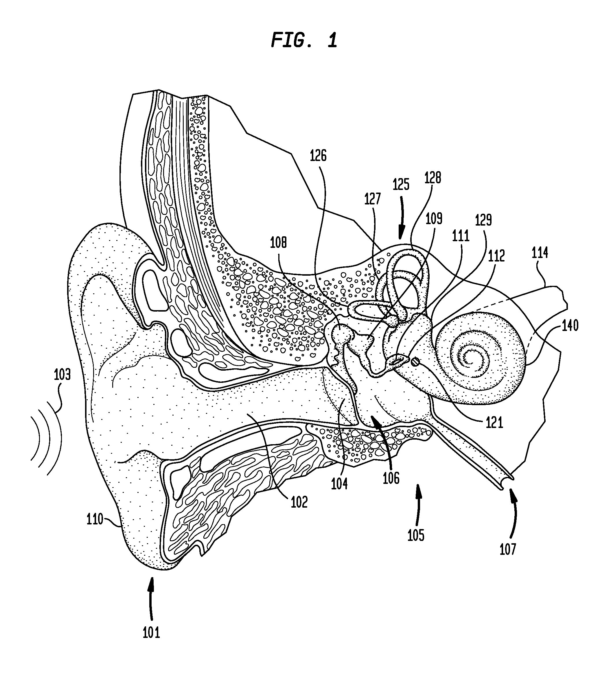 Implantation of a hearing prosthesis