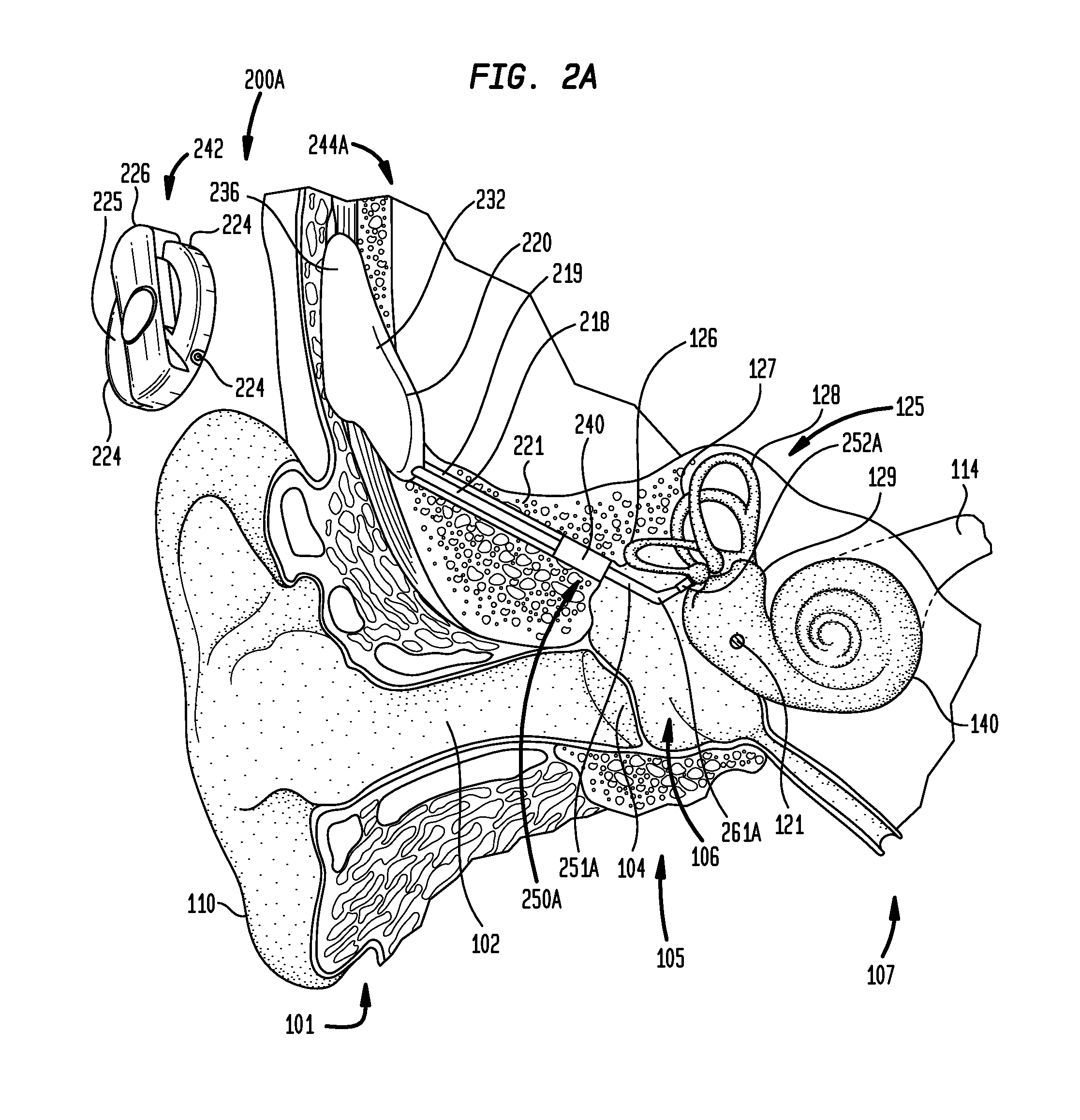 Implantation of a hearing prosthesis