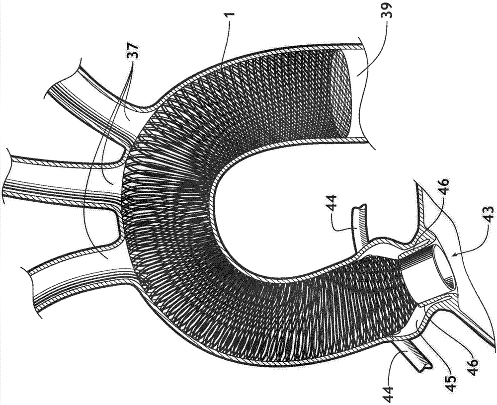 3D filter for prevention of stroke