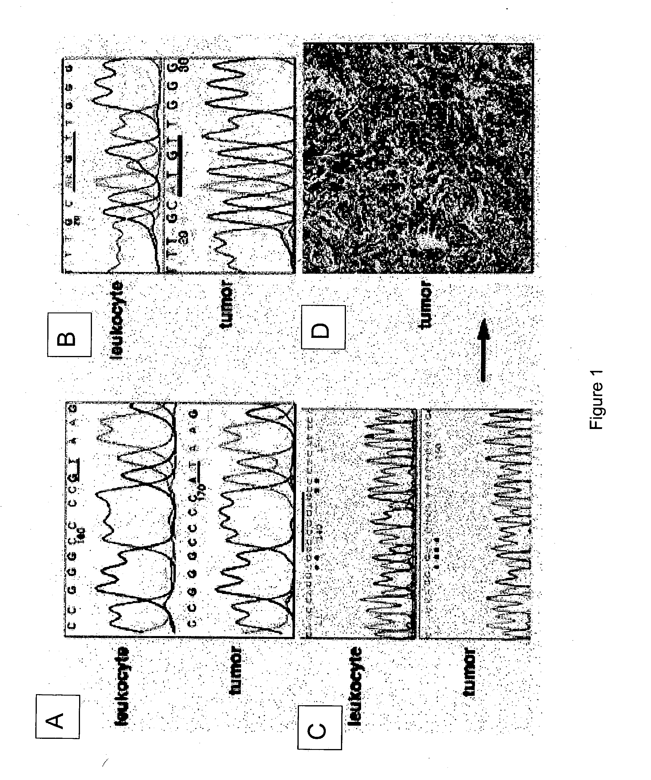 Diagnostic and therapeutic uses of SUFU gene