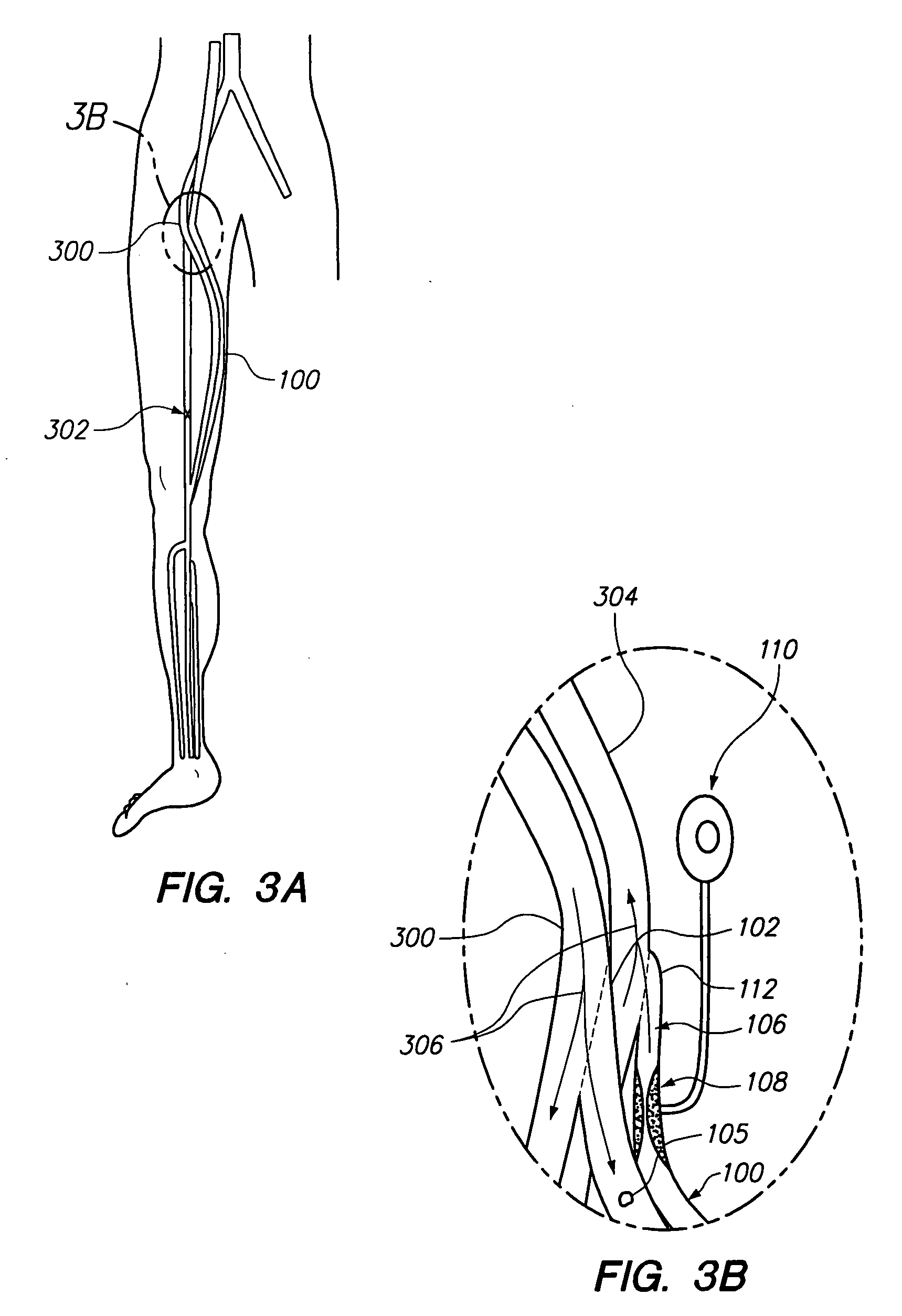 Bypass vascular graft