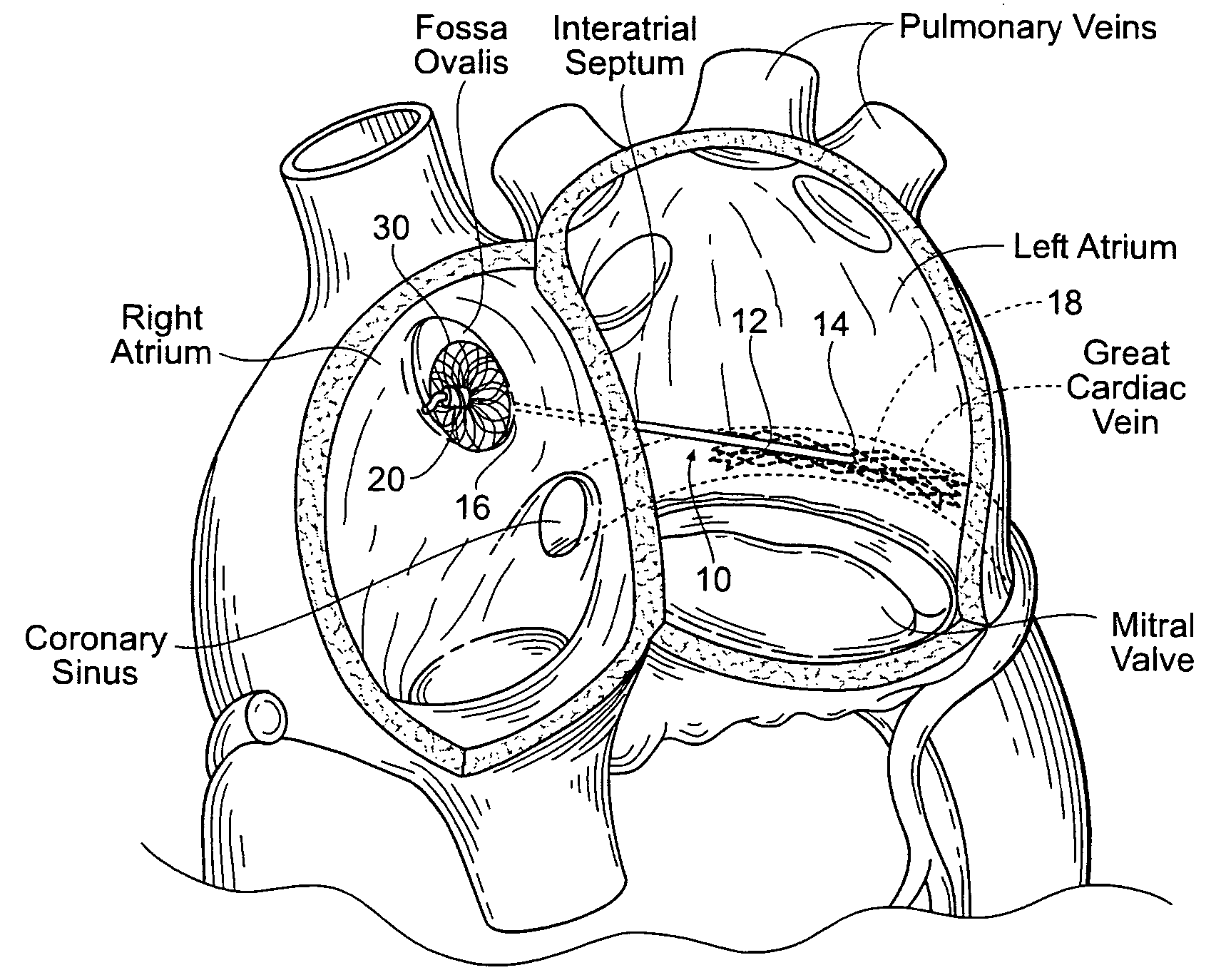 Devices, systems, and methods for reshaping a heart valve annulus, including the use of a bridge implant having an adjustable bridge stop