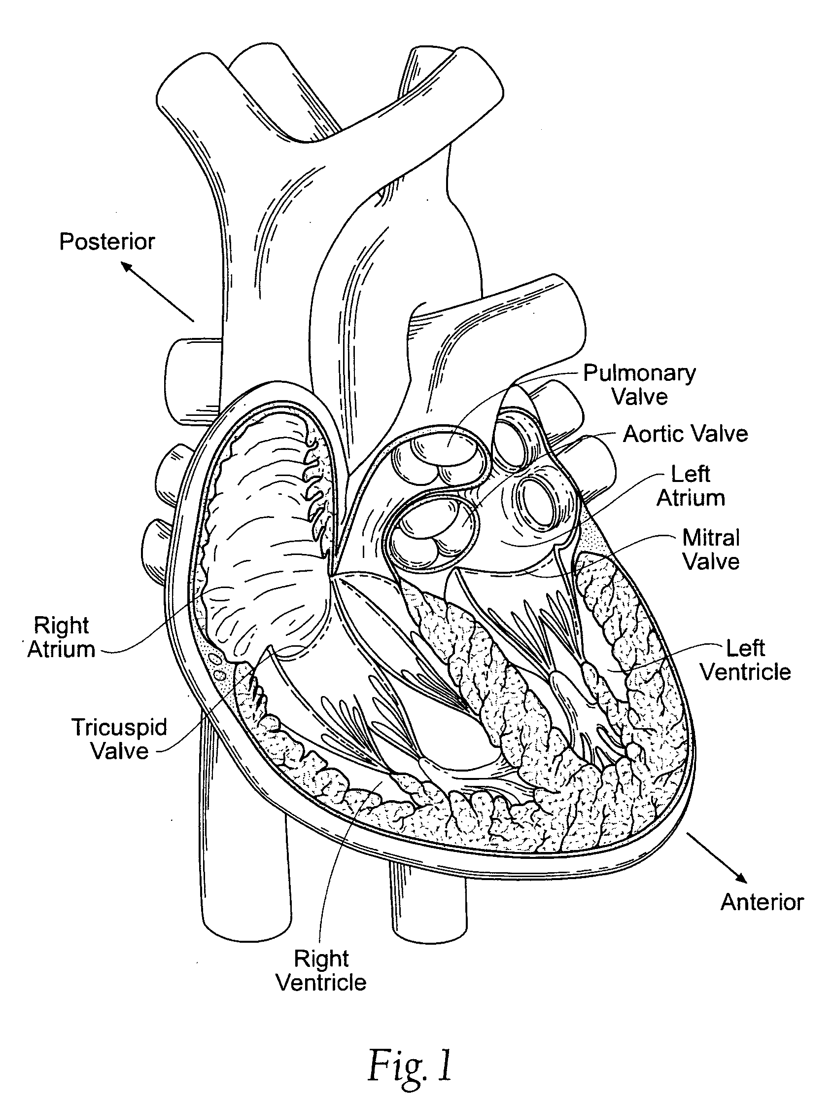 Devices, systems, and methods for reshaping a heart valve annulus, including the use of a bridge implant having an adjustable bridge stop