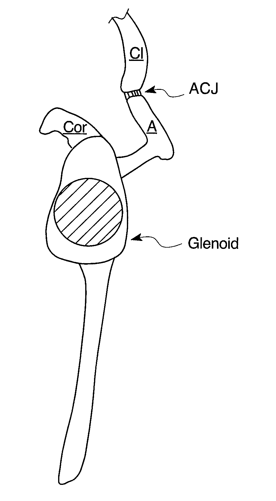 Methods and devices for less invasive glenoid replacement