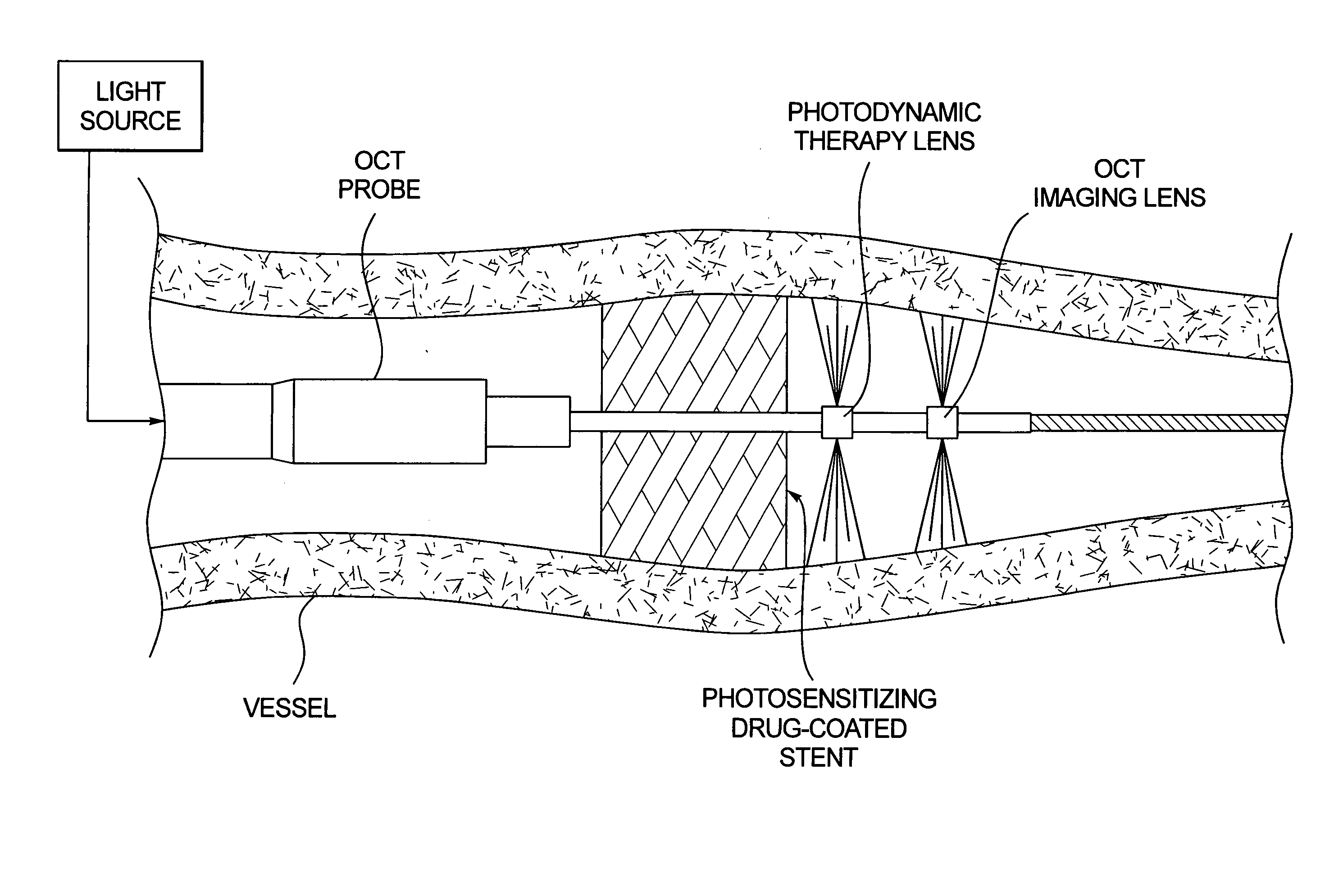 Combined OCT catheter device and method for combined optical coherence tomography (OCT) diagnosis and photodynamic therapy (PDT)