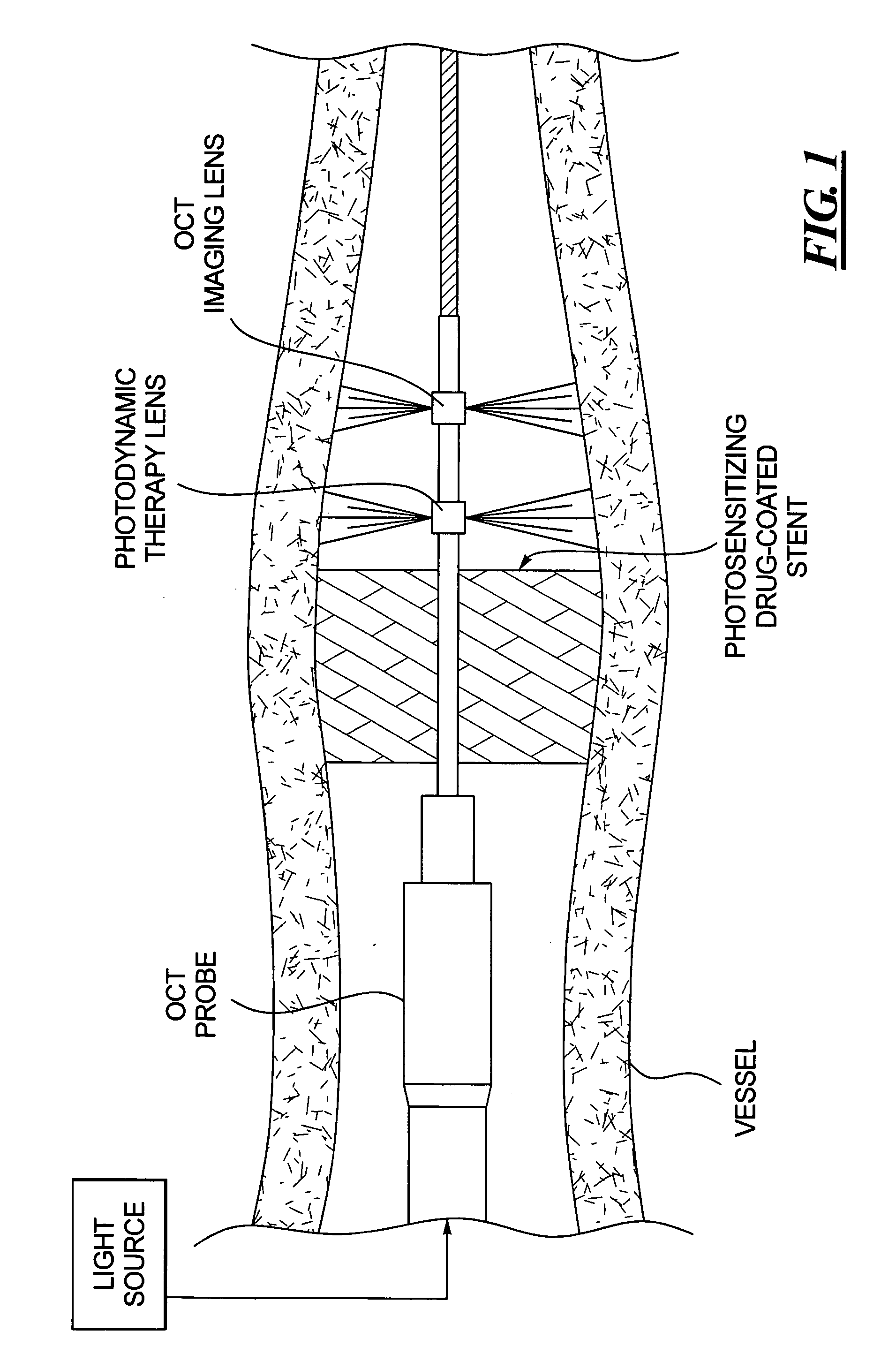 Combined OCT catheter device and method for combined optical coherence tomography (OCT) diagnosis and photodynamic therapy (PDT)