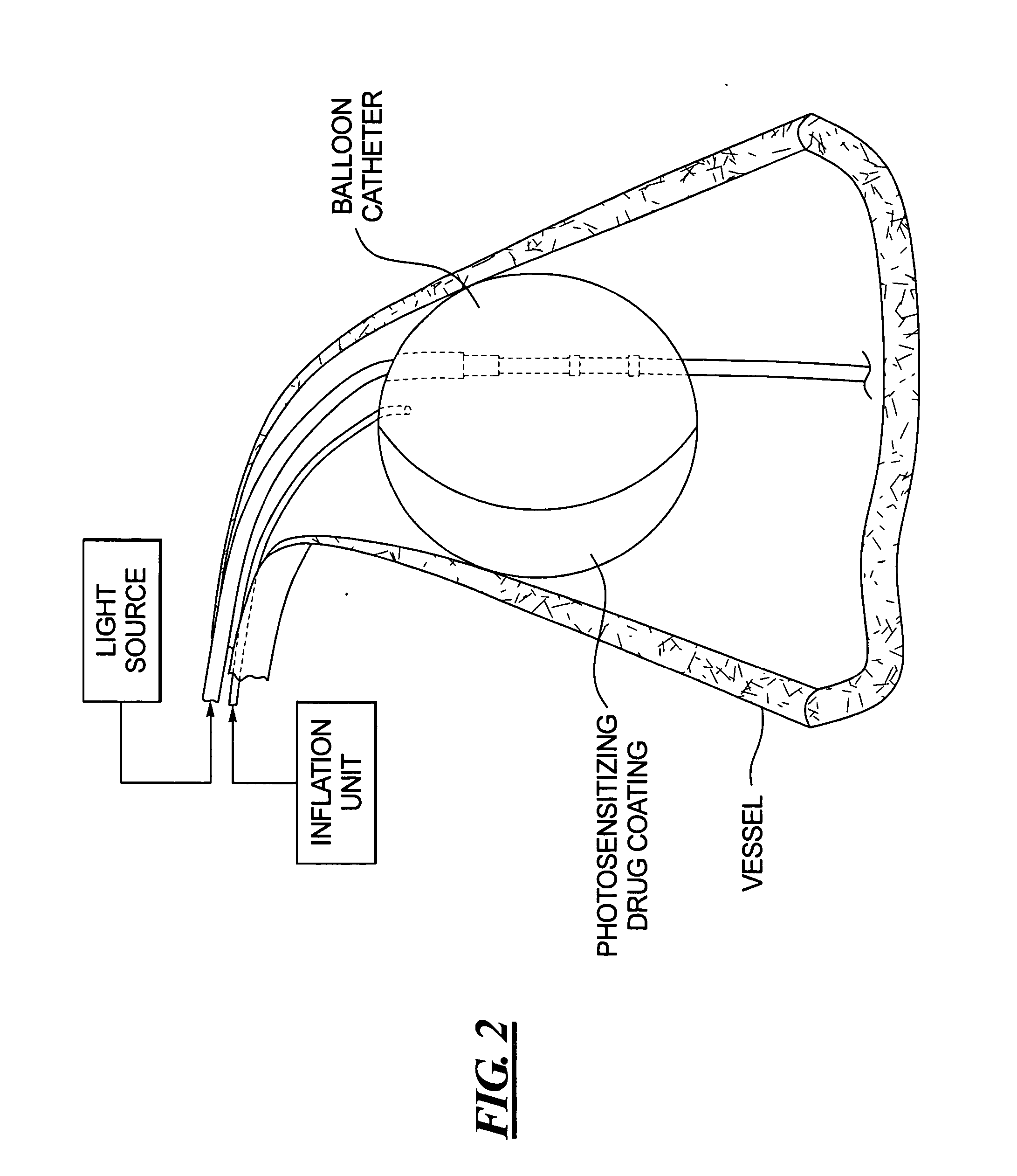 Combined OCT catheter device and method for combined optical coherence tomography (OCT) diagnosis and photodynamic therapy (PDT)